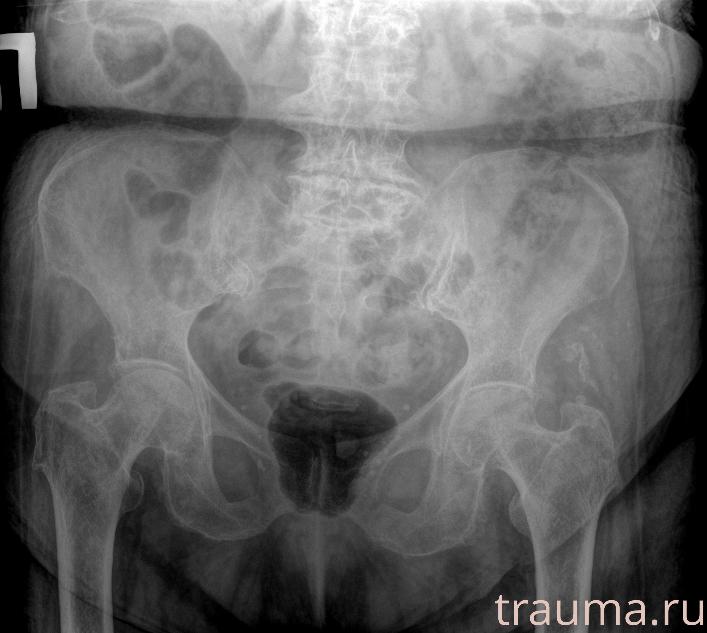 Рентген на дому: по вашему адресу приезжает врач-рентгенолог, травматолог-ортопед с мобильным рентгеновским аппаратом, проводит диагностику травмы или заболевания, делает необходимые рентгенограммы, дает рекомендации по дальнейшему лечению. Получить качественные снимки в домашних условиях возможно благодаря уникальной методике, разработанной МосРентген Центром для института  Склифосовского