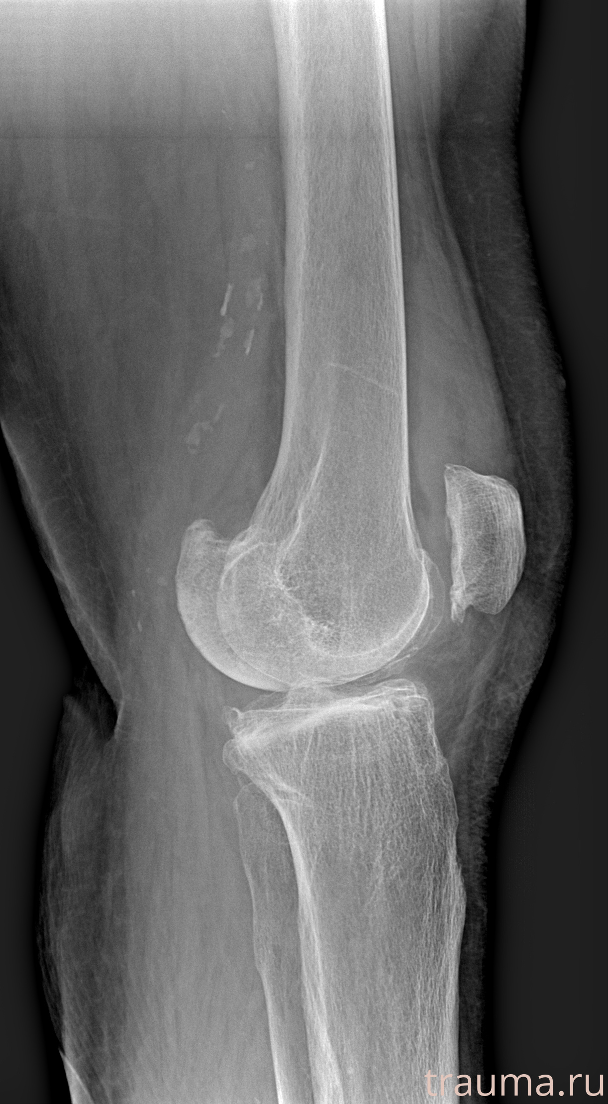 Рентген на дому: по вашему адресу приезжает врач-рентгенолог, травматолог-ортопед с мобильным рентгеновским аппаратом, проводит диагностику травмы или заболевания, делает необходимые рентгенограммы, дает рекомендации по дальнейшему лечению. Получить качественные снимки в домашних условиях возможно благодаря уникальной методике, разработанной МосРентген Центром для института  Склифосовского