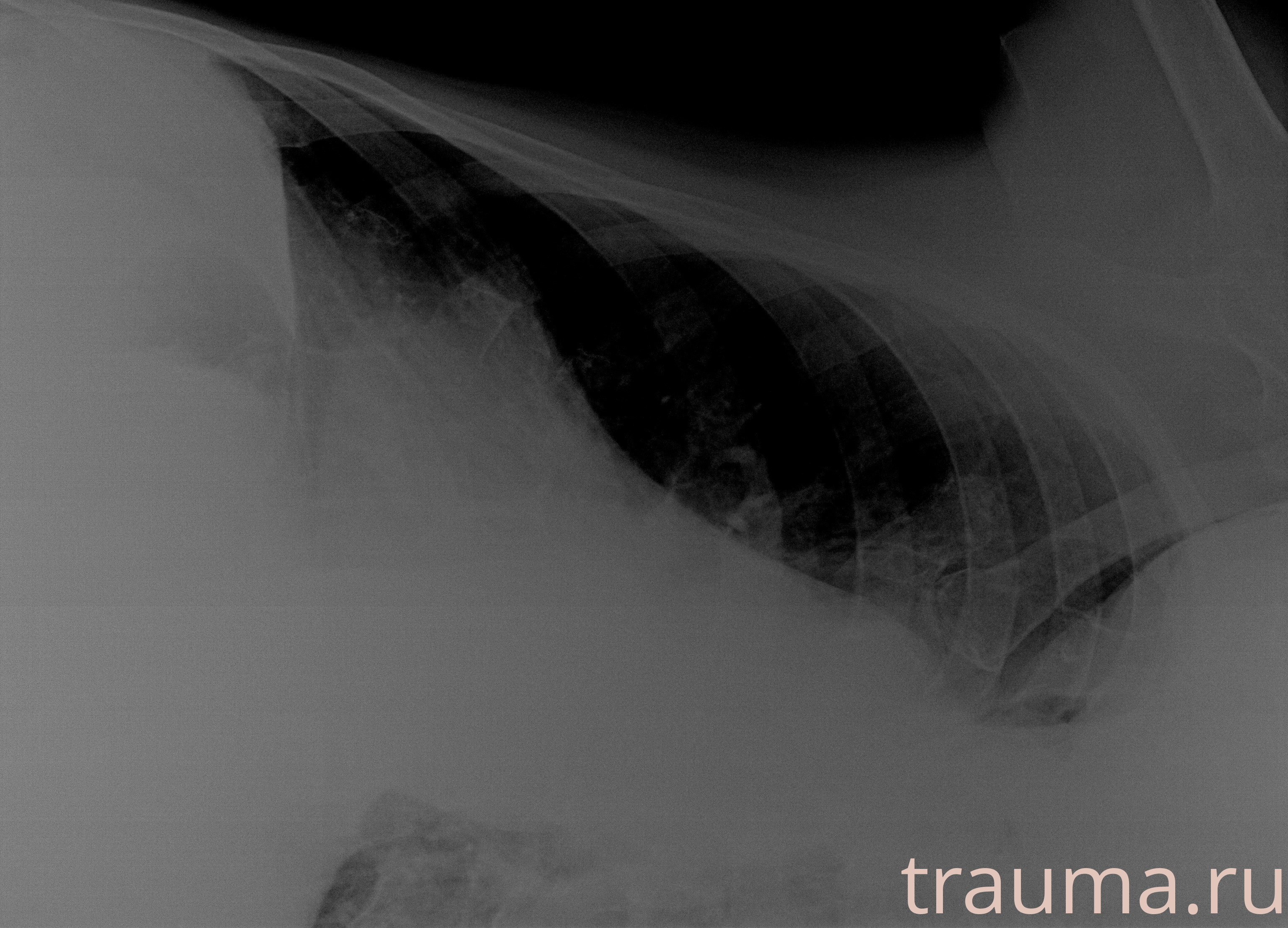 Рентген на дому: по вашему адресу приезжает врач-рентгенолог, травматолог-ортопед с мобильным рентгеновским аппаратом, проводит диагностику травмы или заболевания, делает необходимые рентгенограммы, дает рекомендации по дальнейшему лечению. Получить качественные снимки в домашних условиях возможно благодаря уникальной методике, разработанной МосРентген Центром для института  Склифосовского