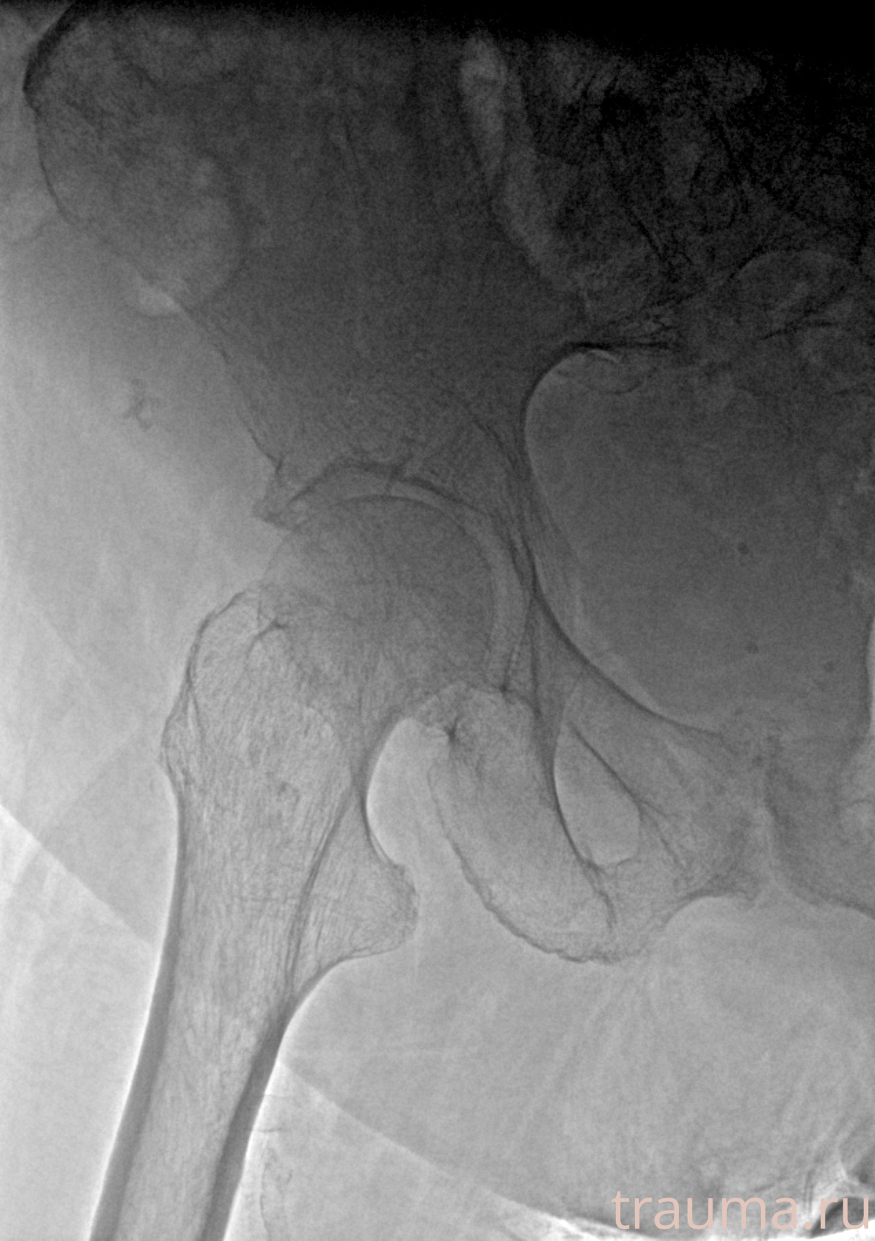 Рентген на дому: по вашему адресу приезжает врач-рентгенолог, травматолог-ортопед с мобильным рентгеновским аппаратом, проводит диагностику травмы или заболевания, делает необходимые рентгенограммы, дает рекомендации по дальнейшему лечению. Получить качественные снимки в домашних условиях возможно благодаря уникальной методике, разработанной МосРентген Центром для института  Склифосовского