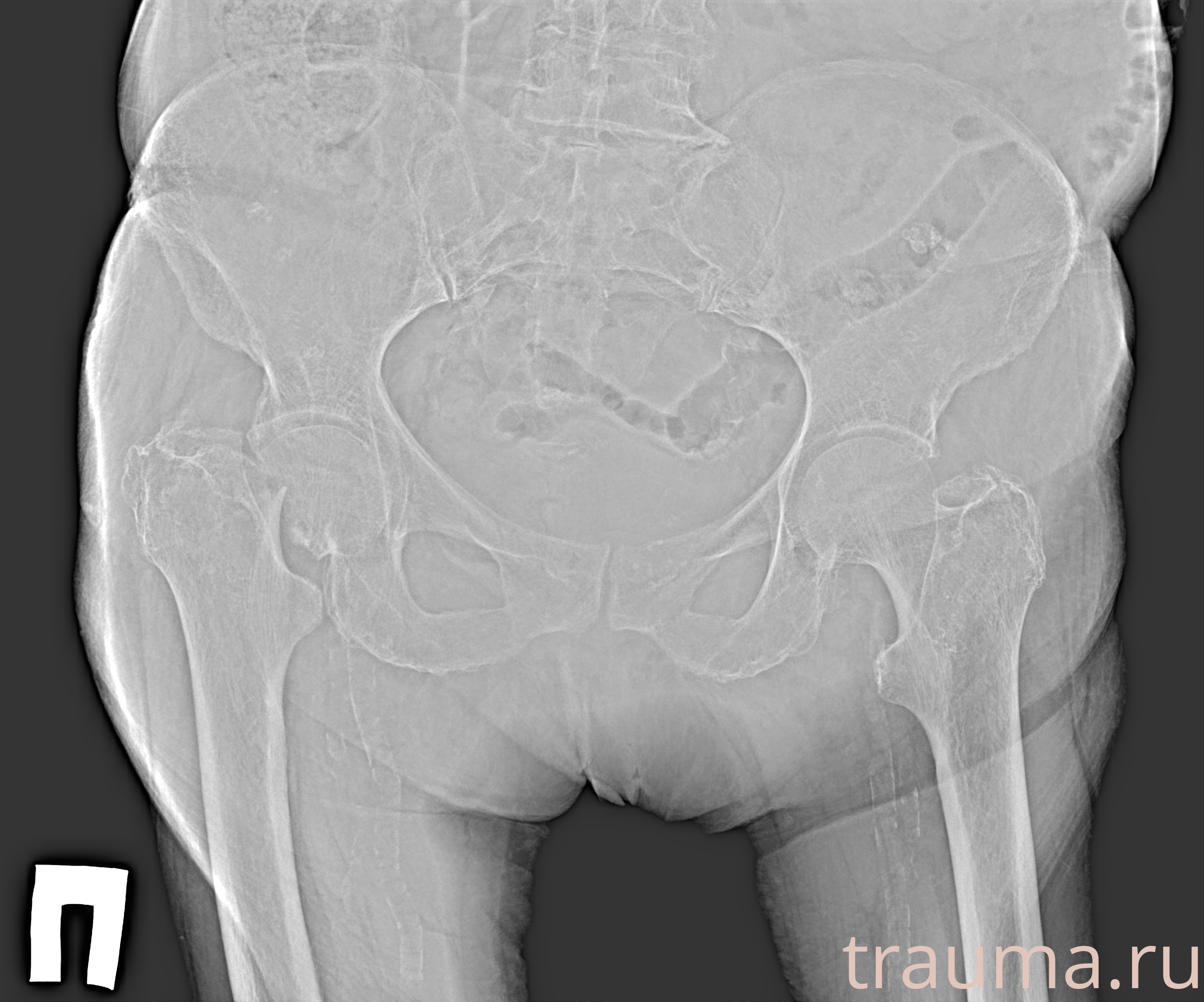 Рентген на дому: по вашему адресу приезжает врач-рентгенолог, травматолог-ортопед с мобильным рентгеновским аппаратом, проводит диагностику травмы или заболевания, делает необходимые рентгенограммы, дает рекомендации по дальнейшему лечению. Получить качественные снимки в домашних условиях возможно благодаря уникальной методике, разработанной МосРентген Центром для института  Склифосовского