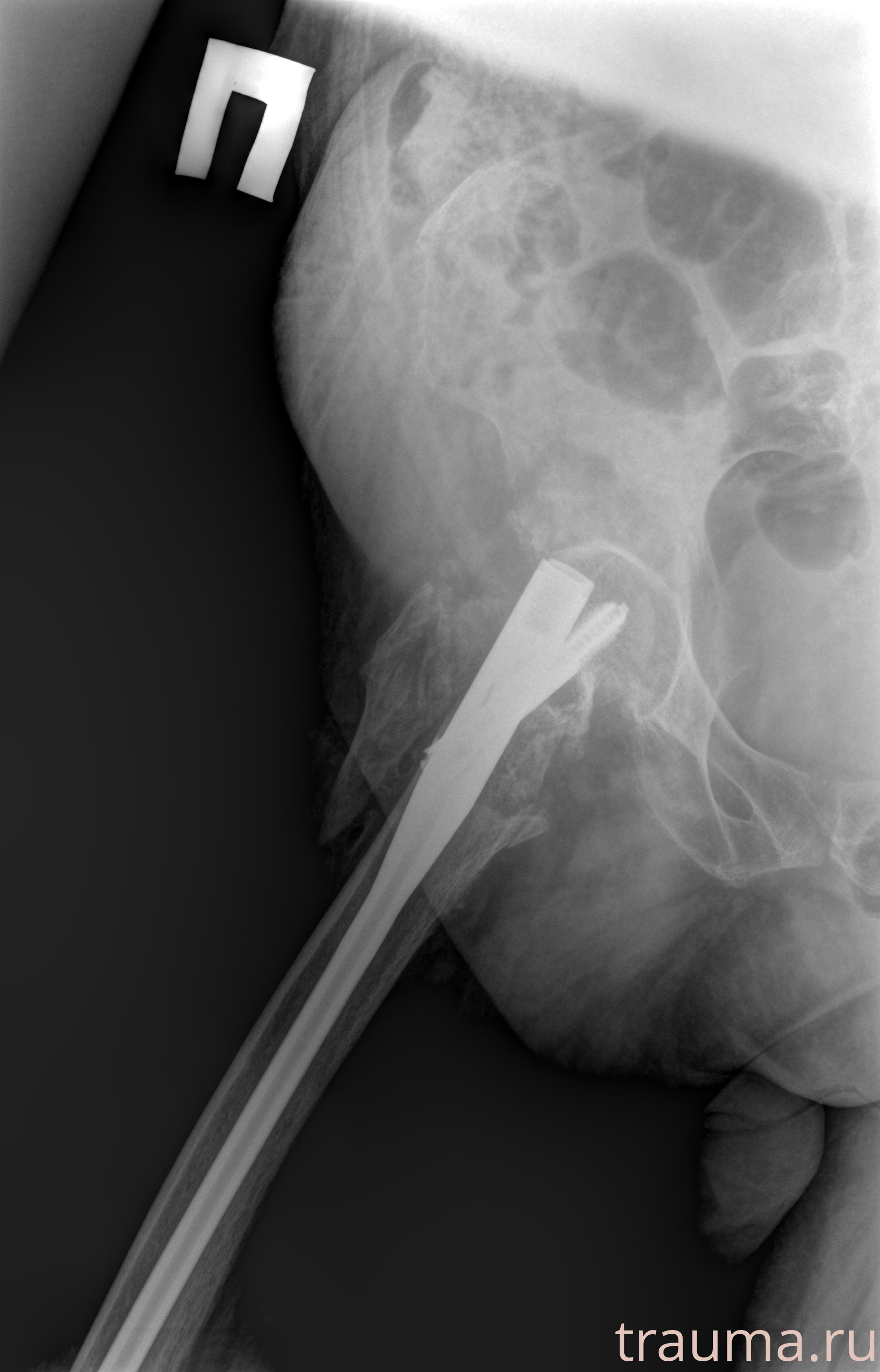 Рентген на дому: по вашему адресу приезжает врач-рентгенолог, травматолог-ортопед с мобильным рентгеновским аппаратом, проводит диагностику травмы или заболевания, делает необходимые рентгенограммы, дает рекомендации по дальнейшему лечению. Получить качественные снимки в домашних условиях возможно благодаря уникальной методике, разработанной МосРентген Центром для института  Склифосовского