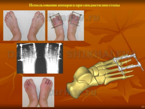 Применение аппарата наружной фиксации для лечения больных синдактилией кисти Применение аппарата наружной фиксации для лечения больных синдактилией кисти