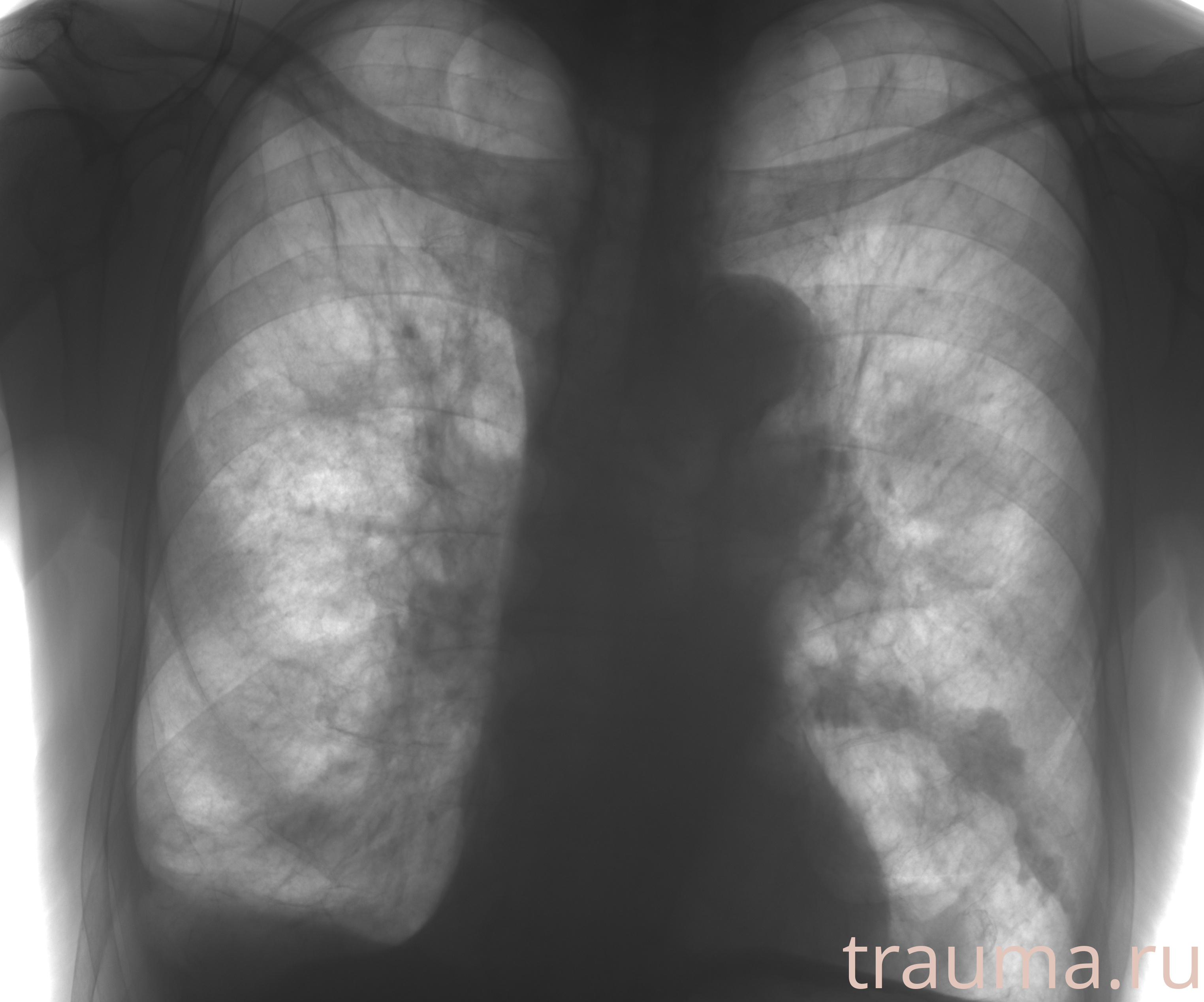 Рентген на дому: по вашему адресу приезжает врач-рентгенолог, травматолог-ортопед с мобильным рентгеновским аппаратом, проводит диагностику травмы или заболевания, делает необходимые рентгенограммы, дает рекомендации по дальнейшему лечению. Получить качественные снимки в домашних условиях возможно благодаря уникальной методике, разработанной МосРентген Центром для института  Склифосовского