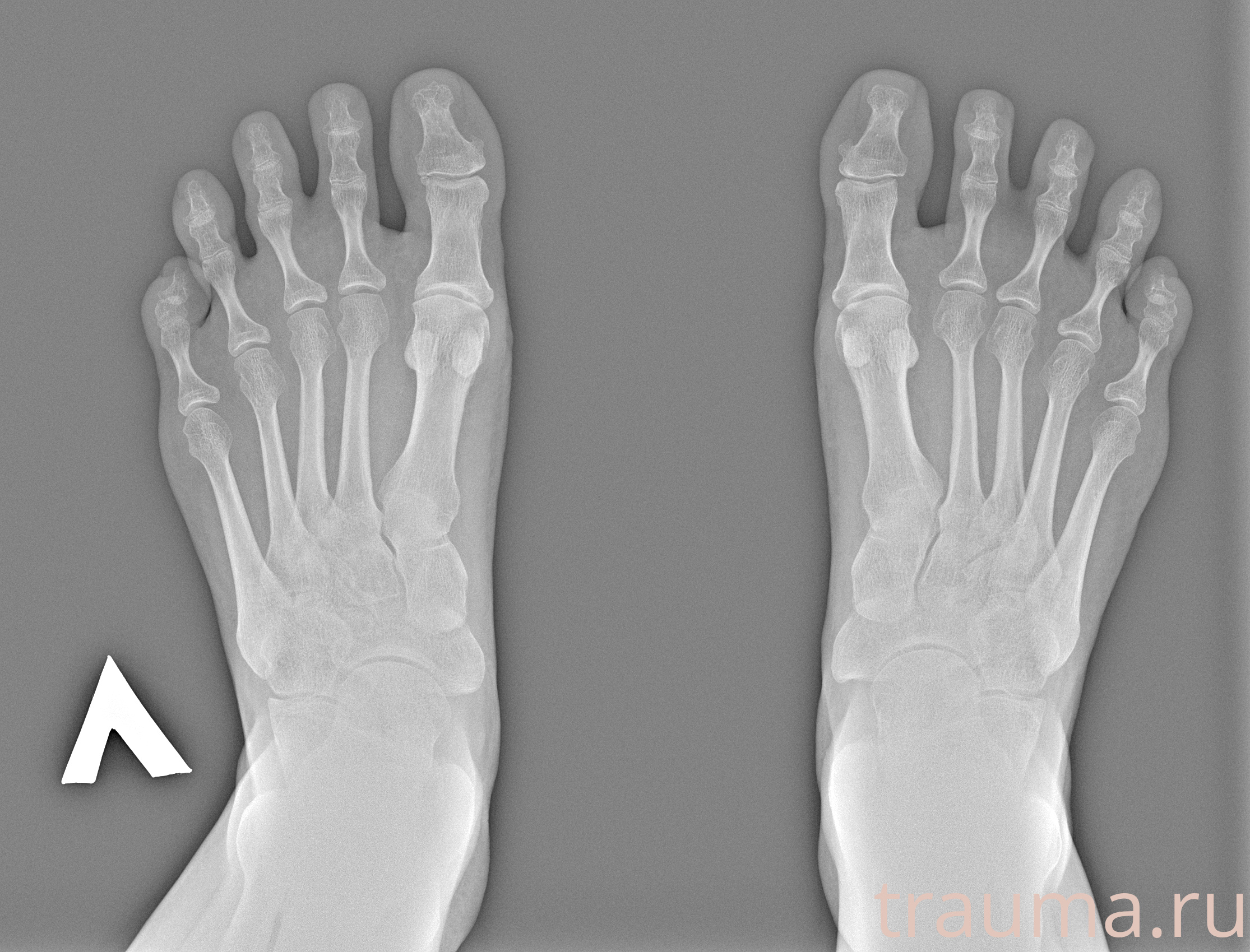 Рентген на дому: по вашему адресу приезжает врач-рентгенолог, травматолог-ортопед с мобильным рентгеновским аппаратом, проводит диагностику травмы или заболевания, делает необходимые рентгенограммы, дает рекомендации по дальнейшему лечению. Получить качественные снимки в домашних условиях возможно благодаря уникальной методике, разработанной МосРентген Центром для института  Склифосовского