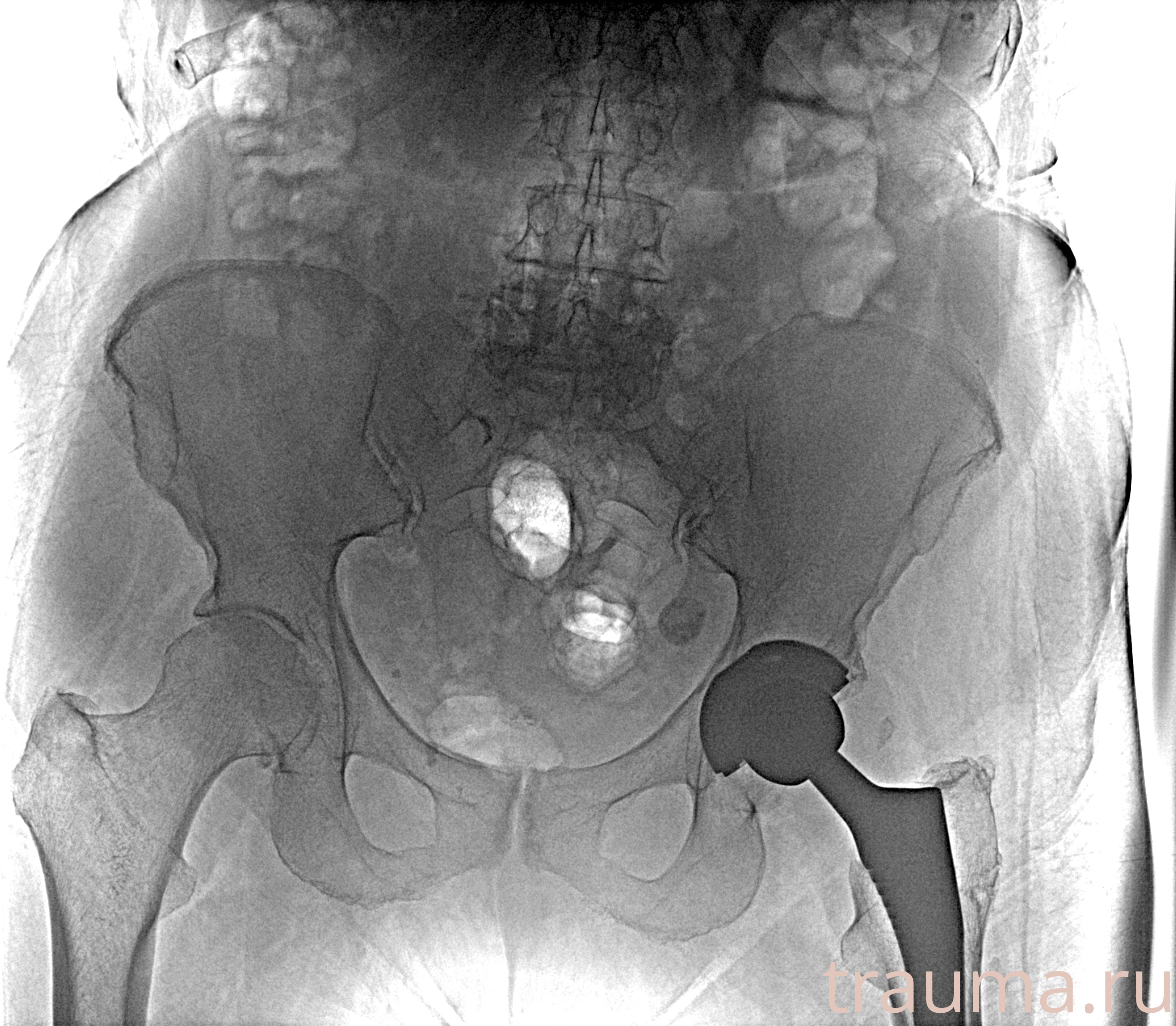 Рентген на дому: по вашему адресу приезжает врач-рентгенолог, травматолог-ортопед с мобильным рентгеновским аппаратом, проводит диагностику травмы или заболевания, делает необходимые рентгенограммы, дает рекомендации по дальнейшему лечению. Получить качественные снимки в домашних условиях возможно благодаря уникальной методике, разработанной МосРентген Центром для института  Склифосовского
