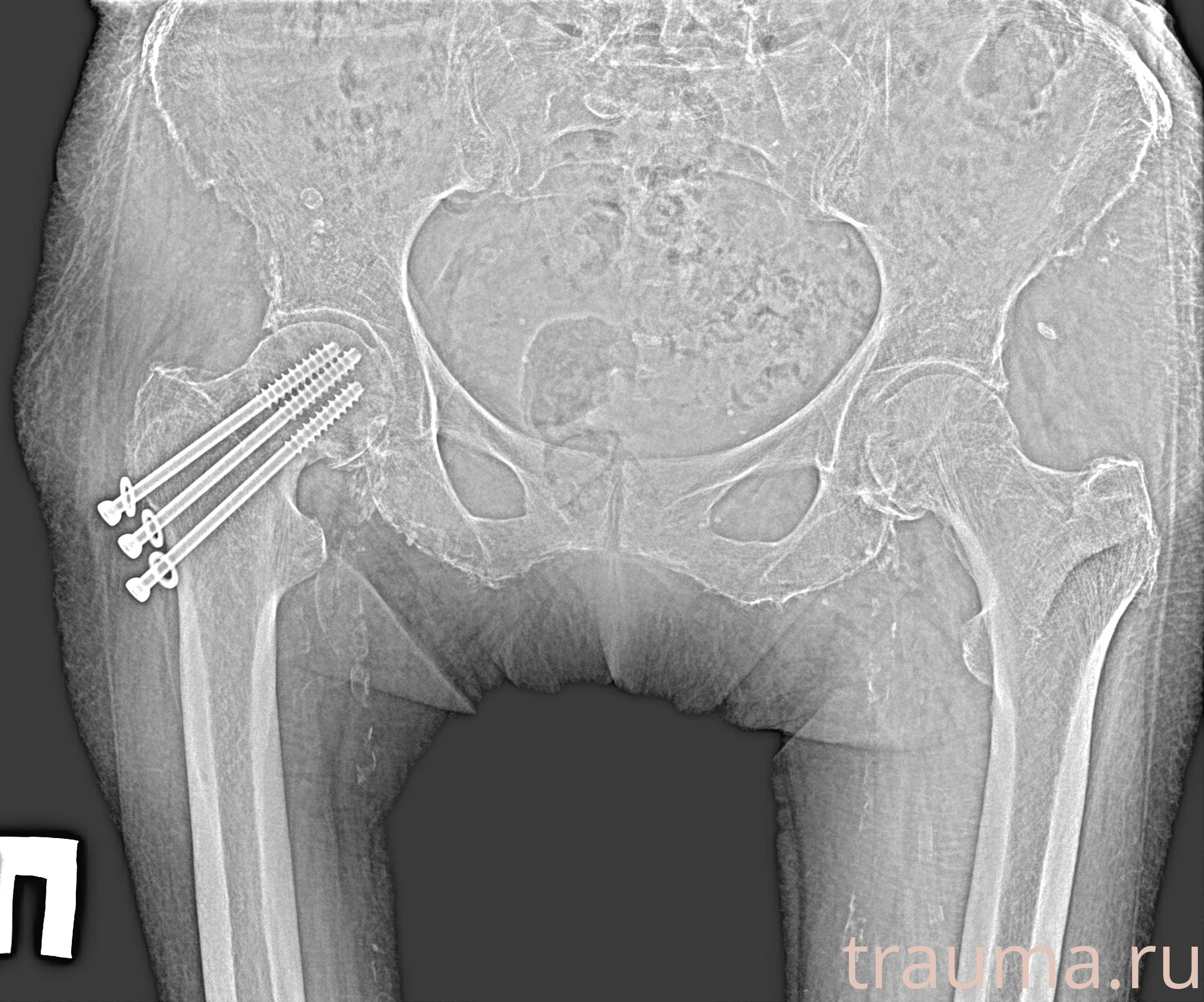 Рентген на дому: по вашему адресу приезжает врач-рентгенолог, травматолог-ортопед с мобильным рентгеновским аппаратом, проводит диагностику травмы или заболевания, делает необходимые рентгенограммы, дает рекомендации по дальнейшему лечению. Получить качественные снимки в домашних условиях возможно благодаря уникальной методике, разработанной МосРентген Центром для института  Склифосовского