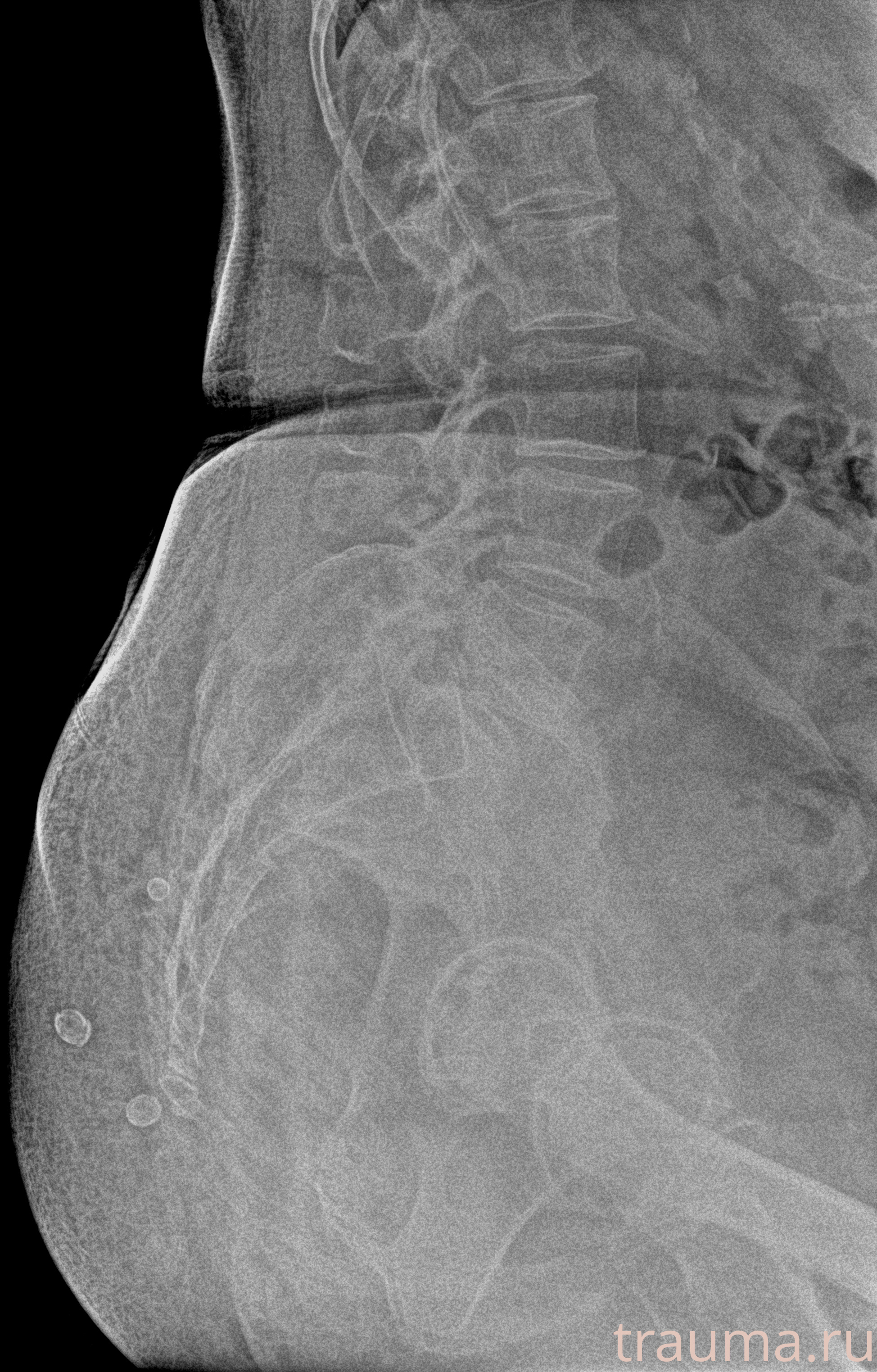 Рентген на дому: по вашему адресу приезжает врач-рентгенолог, травматолог-ортопед с мобильным рентгеновским аппаратом, проводит диагностику травмы или заболевания, делает необходимые рентгенограммы, дает рекомендации по дальнейшему лечению. Получить качественные снимки в домашних условиях возможно благодаря уникальной методике, разработанной МосРентген Центром для института  Склифосовского