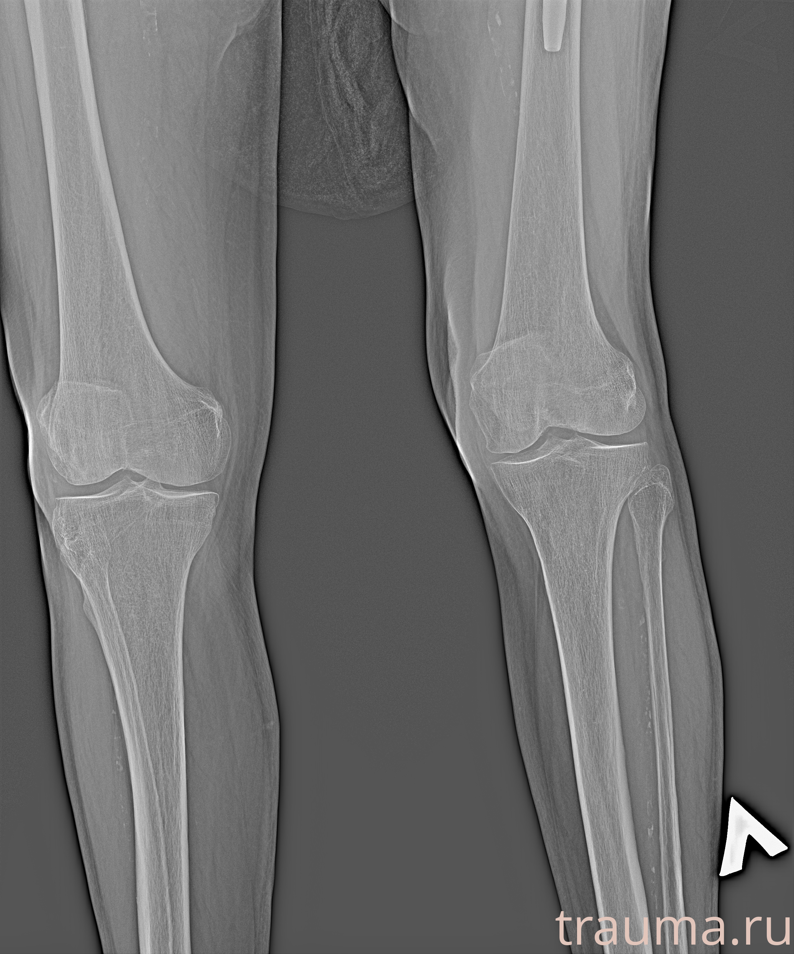 Рентген на дому: по вашему адресу приезжает врач-рентгенолог, травматолог-ортопед с мобильным рентгеновским аппаратом, проводит диагностику травмы или заболевания, делает необходимые рентгенограммы, дает рекомендации по дальнейшему лечению. Получить качественные снимки в домашних условиях возможно благодаря уникальной методике, разработанной МосРентген Центром для института  Склифосовского