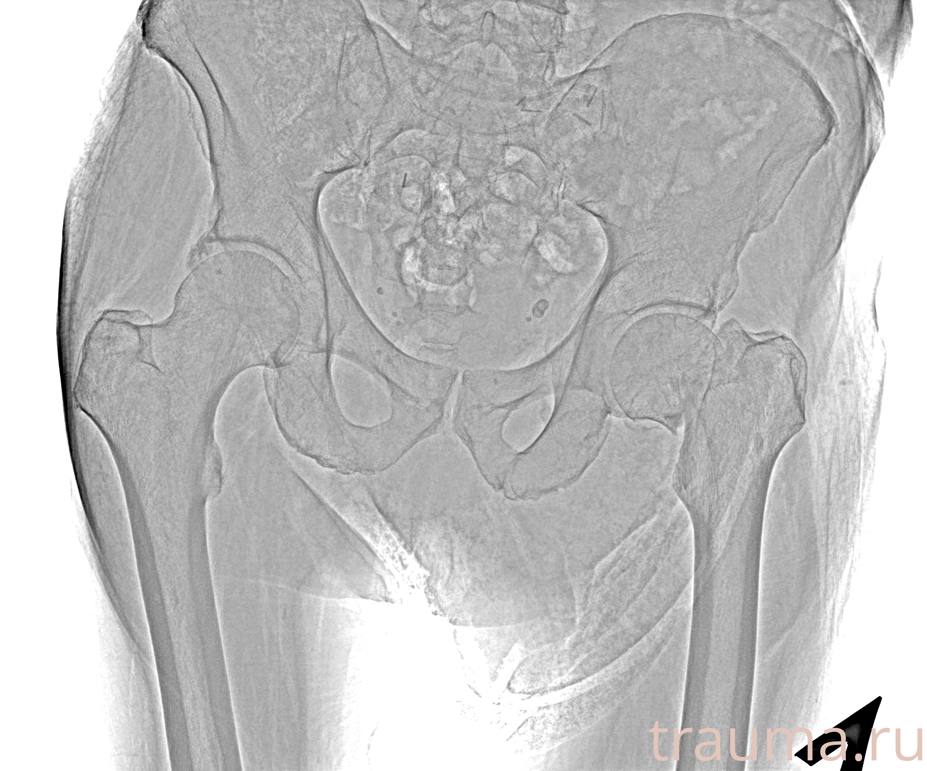 Рентген на дому: по вашему адресу приезжает врач-рентгенолог, травматолог-ортопед с мобильным рентгеновским аппаратом, проводит диагностику травмы или заболевания, делает необходимые рентгенограммы, дает рекомендации по дальнейшему лечению. Получить качественные снимки в домашних условиях возможно благодаря уникальной методике, разработанной МосРентген Центром для института  Склифосовского