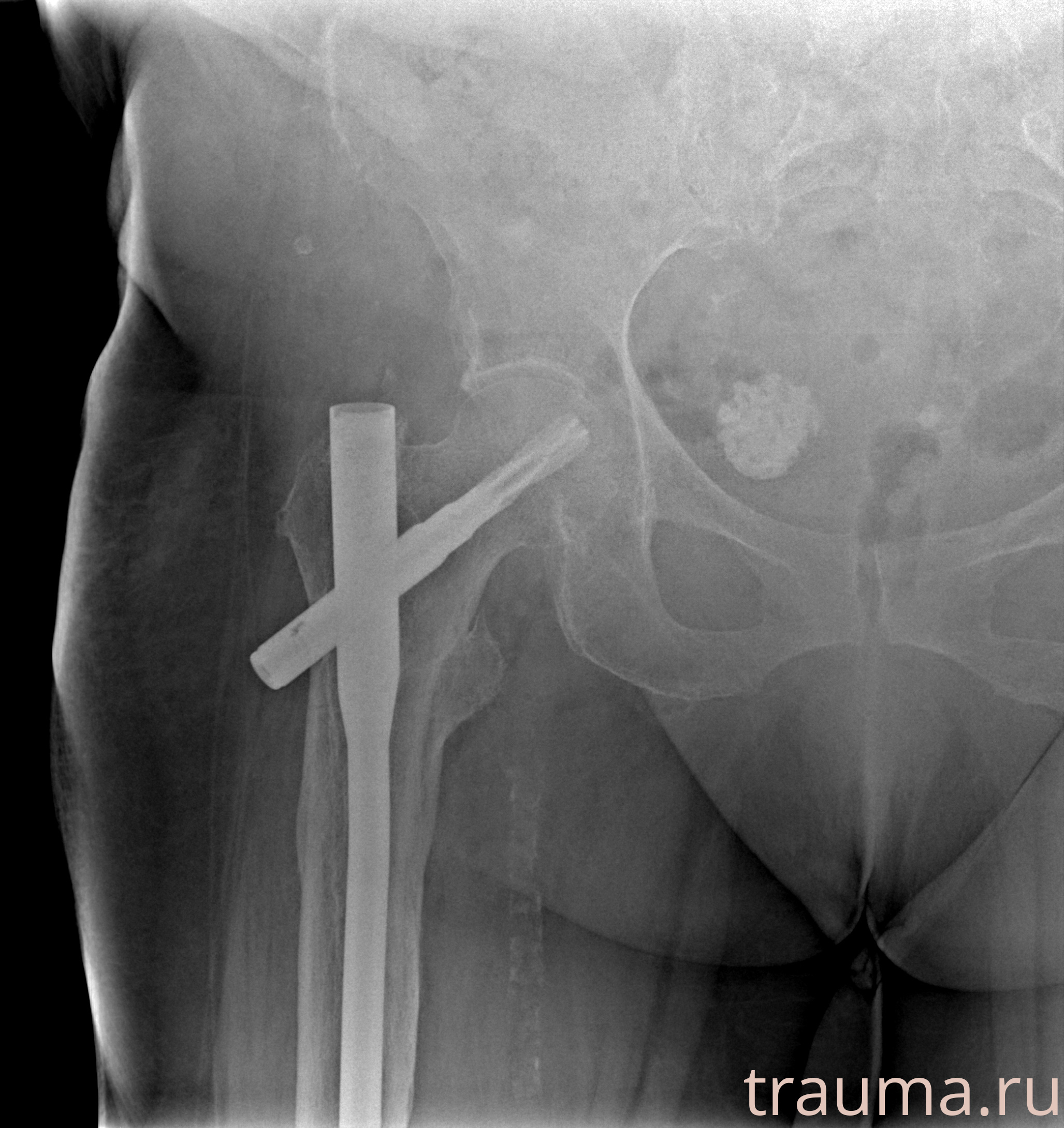 Рентген на дому: по вашему адресу приезжает врач-рентгенолог, травматолог-ортопед с мобильным рентгеновским аппаратом, проводит диагностику травмы или заболевания, делает необходимые рентгенограммы, дает рекомендации по дальнейшему лечению. Получить качественные снимки в домашних условиях возможно благодаря уникальной методике, разработанной МосРентген Центром для института  Склифосовского