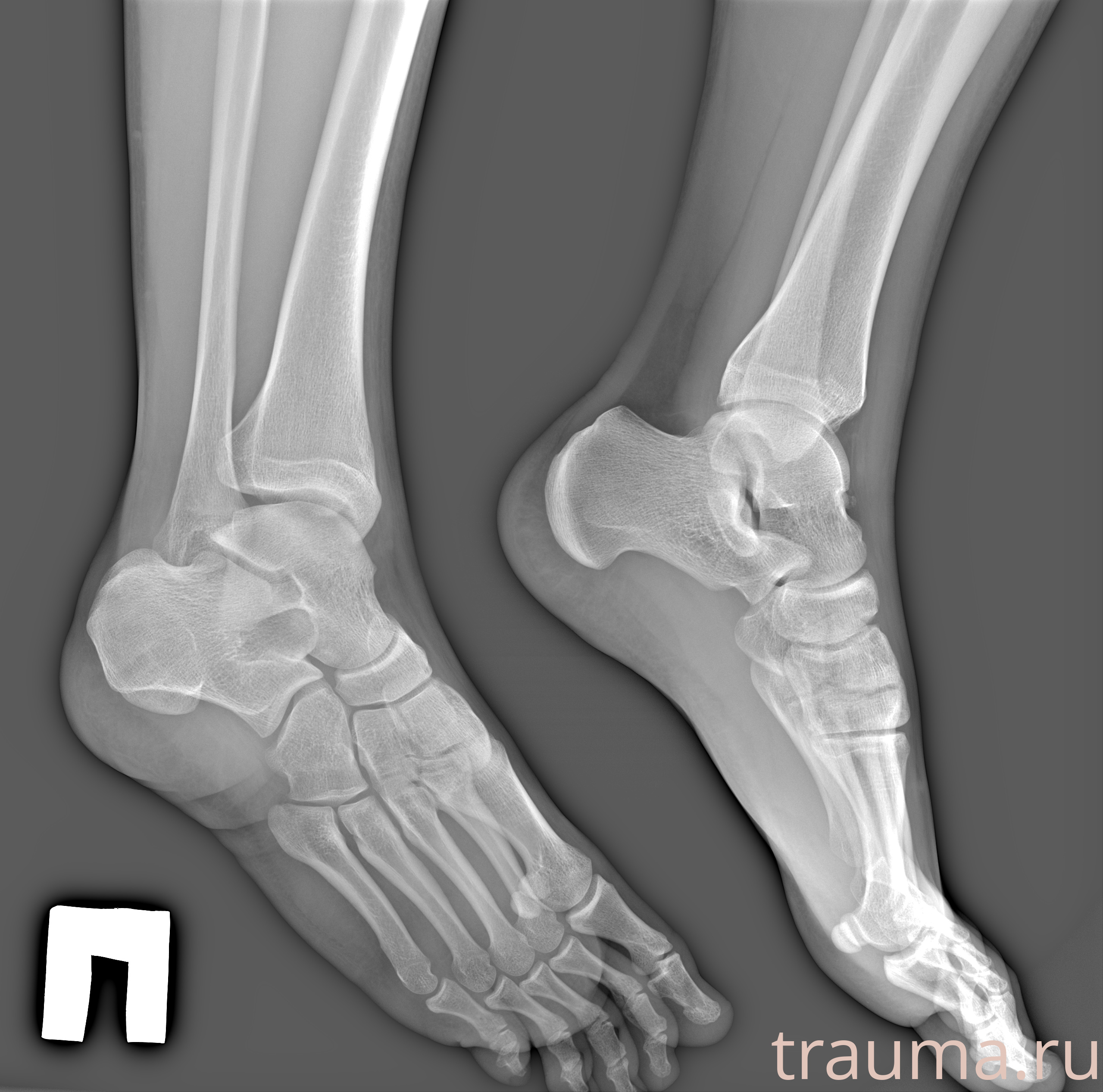 Рентген на дому: по вашему адресу приезжает врач-рентгенолог, травматолог-ортопед с мобильным рентгеновским аппаратом, проводит диагностику травмы или заболевания, делает необходимые рентгенограммы, дает рекомендации по дальнейшему лечению. Получить качественные снимки в домашних условиях возможно благодаря уникальной методике, разработанной МосРентген Центром для института  Склифосовского