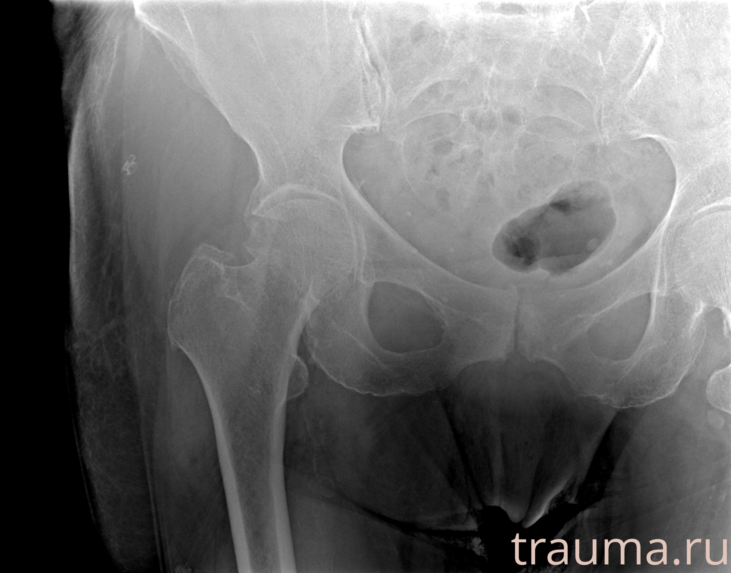 Рентген на дому: по вашему адресу приезжает врач-рентгенолог, травматолог-ортопед с мобильным рентгеновским аппаратом, проводит диагностику травмы или заболевания, делает необходимые рентгенограммы, дает рекомендации по дальнейшему лечению. Получить качественные снимки в домашних условиях возможно благодаря уникальной методике, разработанной МосРентген Центром для института  Склифосовского