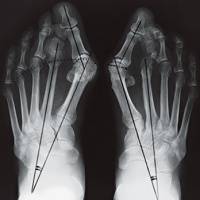Новые направления при лечении больных с Hallux Valgus
методом управляемого чрескостного остеосинтеза
Новые направления при лечении больных с Hallux Valgus
методом управляемого чрескостного остеосинтеза