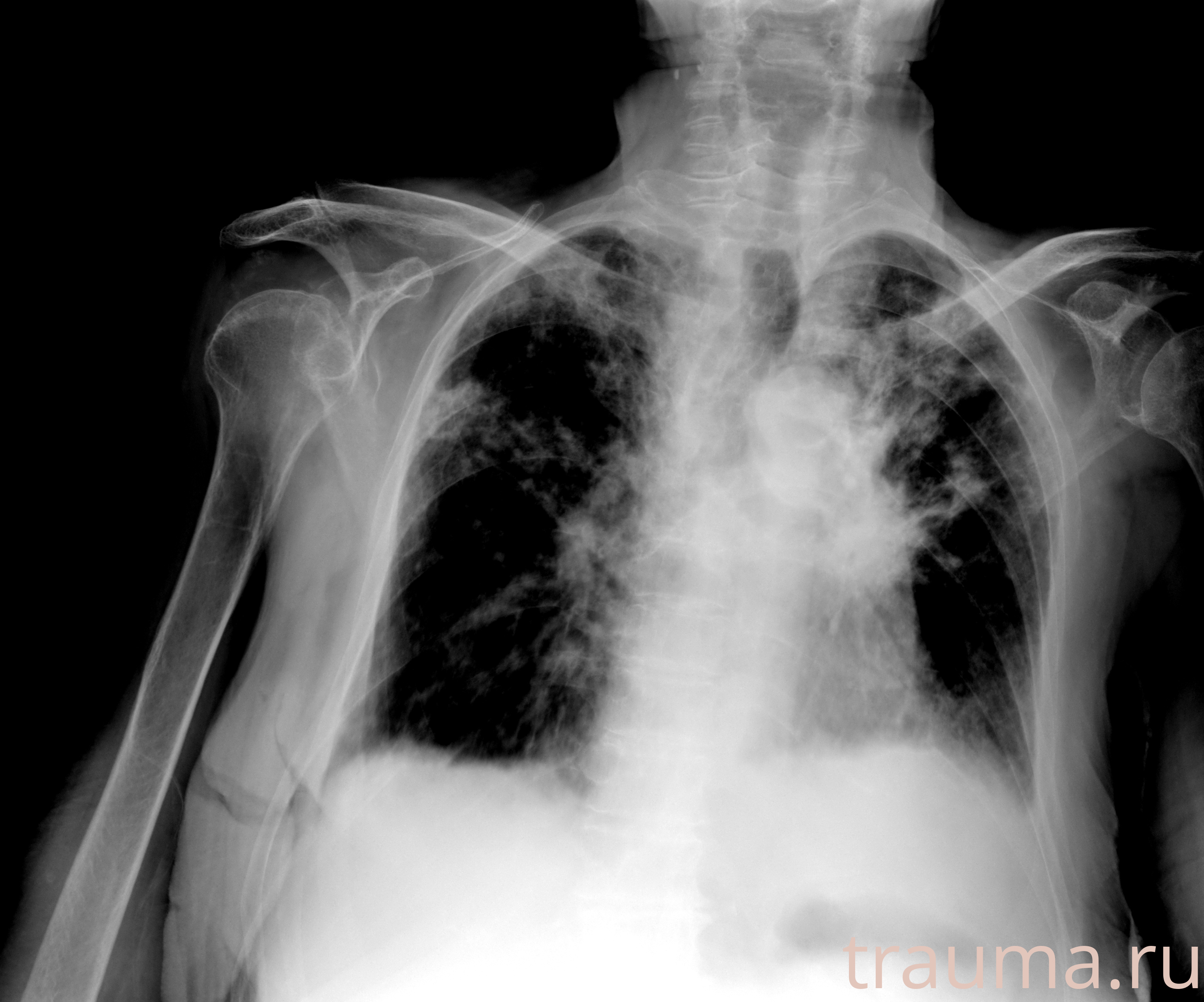 Рентген на дому: по вашему адресу приезжает врач-рентгенолог, травматолог-ортопед с мобильным рентгеновским аппаратом, проводит диагностику травмы или заболевания, делает необходимые рентгенограммы, дает рекомендации по дальнейшему лечению. Получить качественные снимки в домашних условиях возможно благодаря уникальной методике, разработанной МосРентген Центром для института  Склифосовского