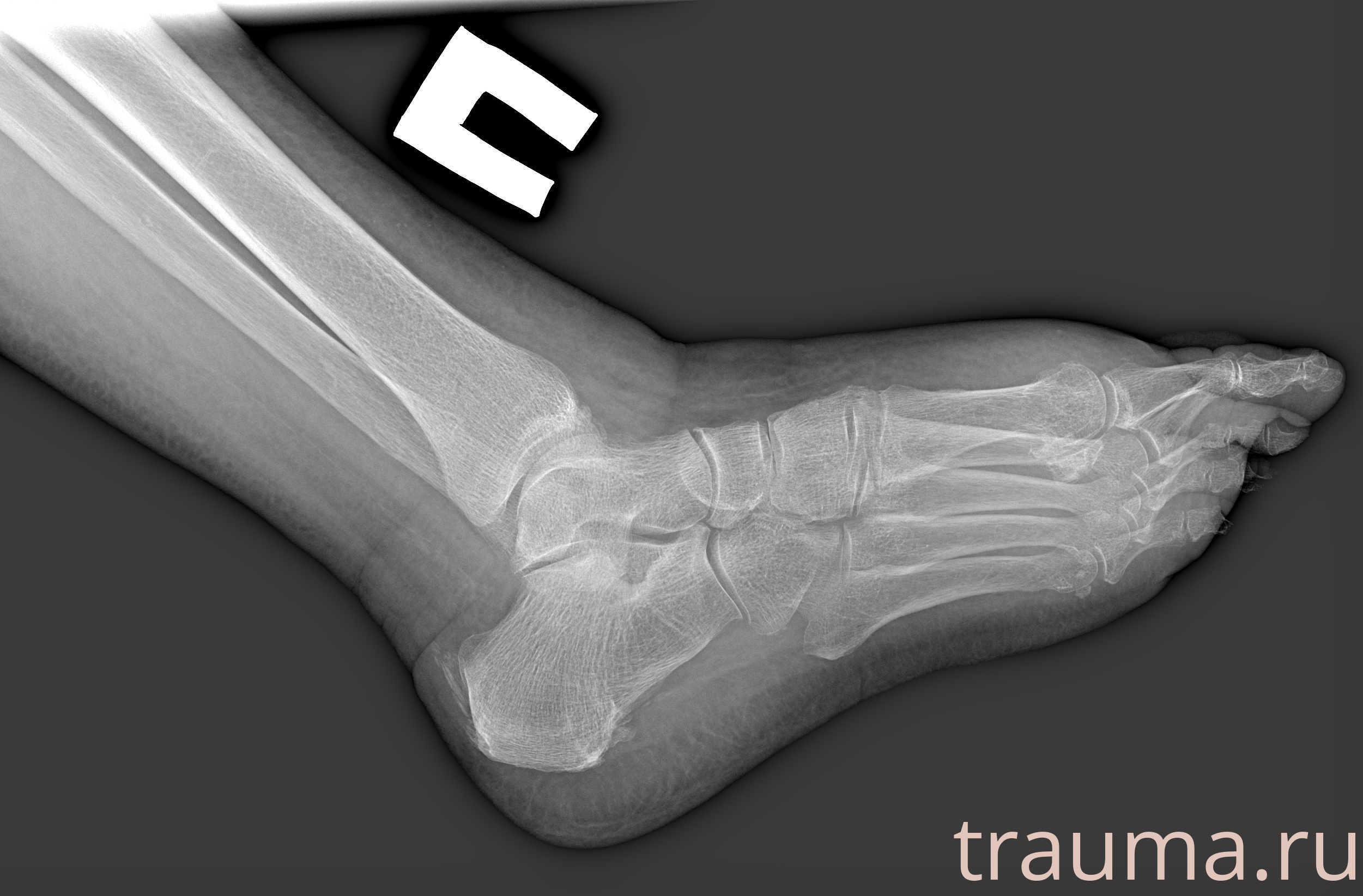 Рентген на дому: по вашему адресу приезжает врач-рентгенолог, травматолог-ортопед с мобильным рентгеновским аппаратом, проводит диагностику травмы или заболевания, делает необходимые рентгенограммы, дает рекомендации по дальнейшему лечению. Получить качественные снимки в домашних условиях возможно благодаря уникальной методике, разработанной МосРентген Центром для института  Склифосовского