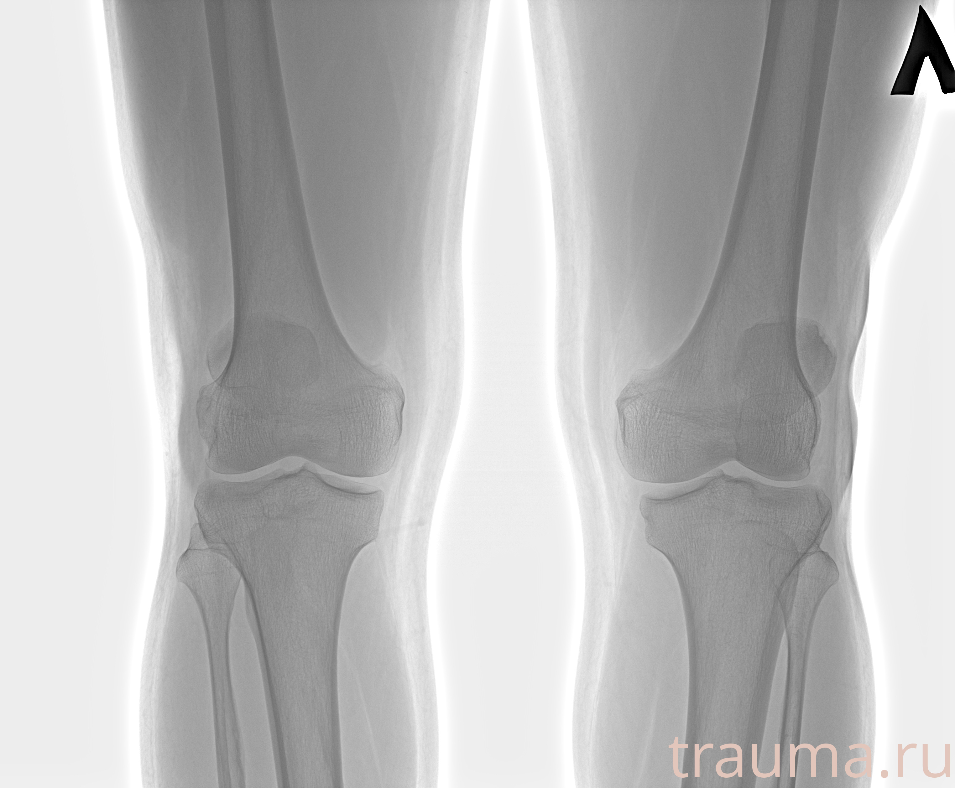 Рентген на дому: по вашему адресу приезжает врач-рентгенолог, травматолог-ортопед с мобильным рентгеновским аппаратом, проводит диагностику травмы или заболевания, делает необходимые рентгенограммы, дает рекомендации по дальнейшему лечению. Получить качественные снимки в домашних условиях возможно благодаря уникальной методике, разработанной МосРентген Центром для института  Склифосовского