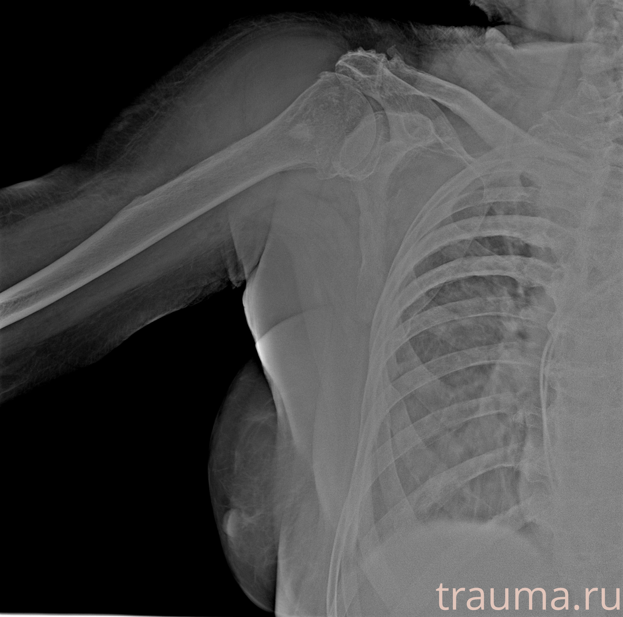 Рентген на дому: по вашему адресу приезжает врач-рентгенолог, травматолог-ортопед с мобильным рентгеновским аппаратом, проводит диагностику травмы или заболевания, делает необходимые рентгенограммы, дает рекомендации по дальнейшему лечению. Получить качественные снимки в домашних условиях возможно благодаря уникальной методике, разработанной МосРентген Центром для института  Склифосовского