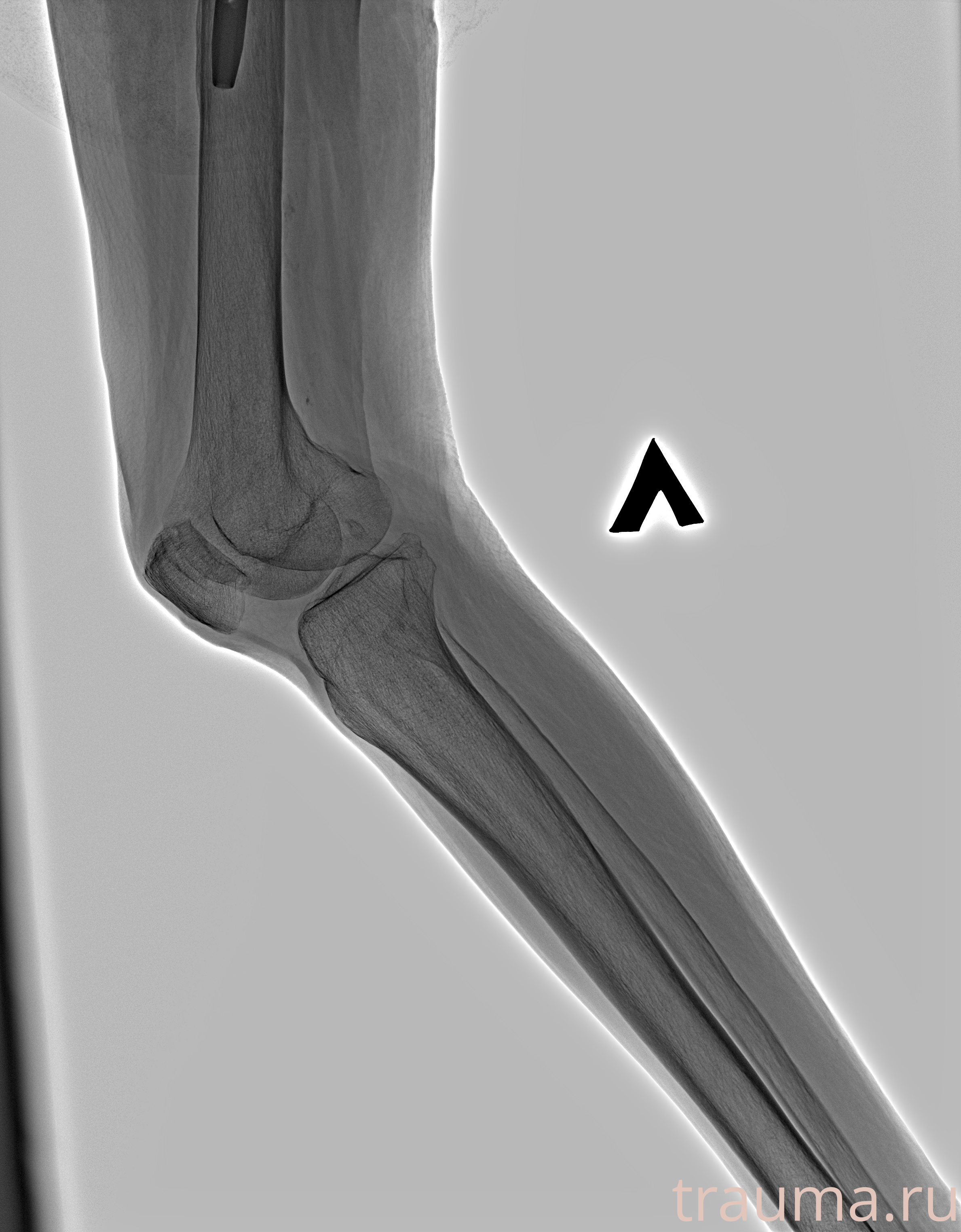 Рентген на дому: по вашему адресу приезжает врач-рентгенолог, травматолог-ортопед с мобильным рентгеновским аппаратом, проводит диагностику травмы или заболевания, делает необходимые рентгенограммы, дает рекомендации по дальнейшему лечению. Получить качественные снимки в домашних условиях возможно благодаря уникальной методике, разработанной МосРентген Центром для института  Склифосовского