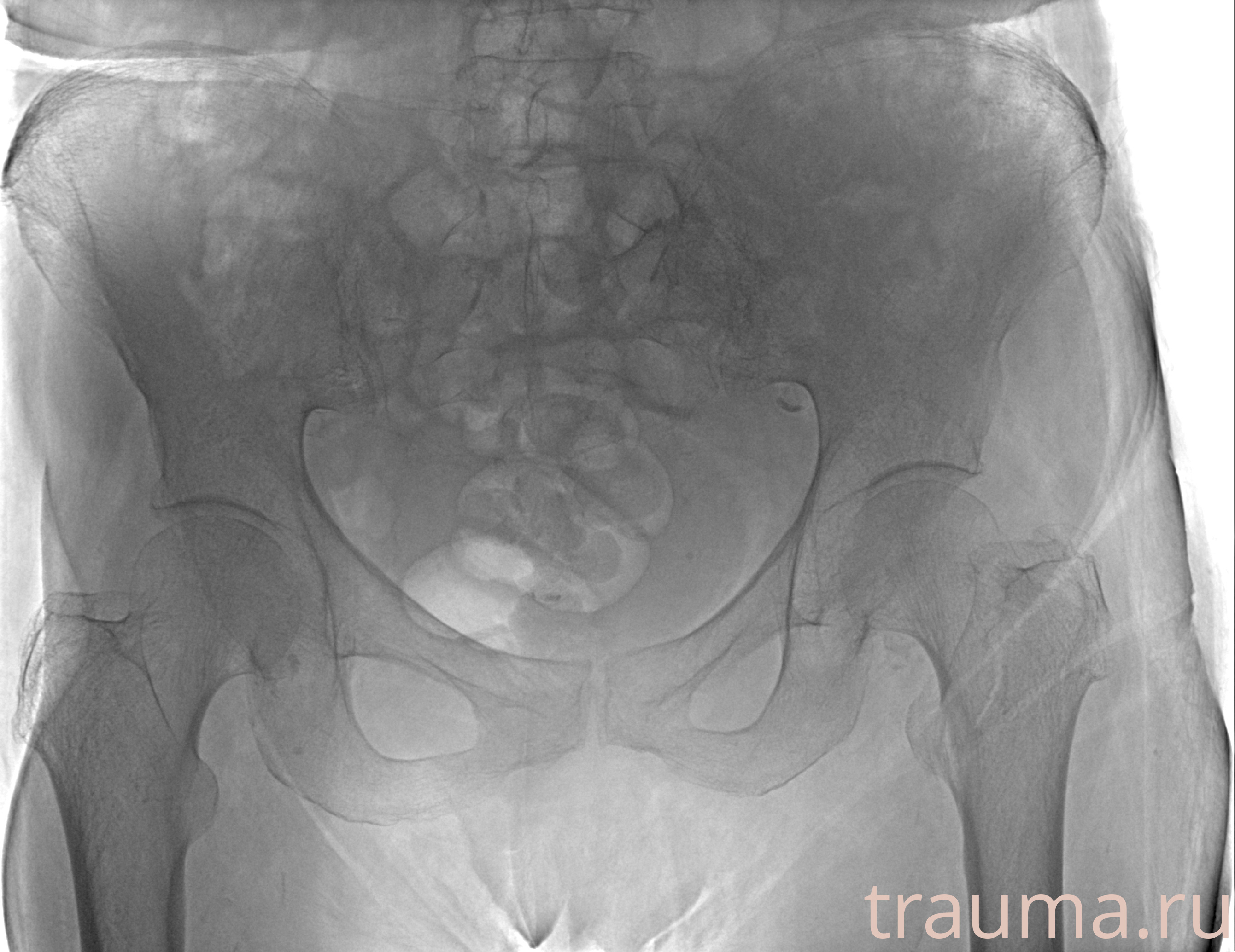 Рентген на дому: по вашему адресу приезжает врач-рентгенолог, травматолог-ортопед с мобильным рентгеновским аппаратом, проводит диагностику травмы или заболевания, делает необходимые рентгенограммы, дает рекомендации по дальнейшему лечению. Получить качественные снимки в домашних условиях возможно благодаря уникальной методике, разработанной МосРентген Центром для института  Склифосовского