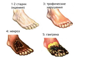 Ортопедические аспекты классификаций синдрома диабетической стопы Ортопедические аспекты классификаций синдрома диабетической стопы