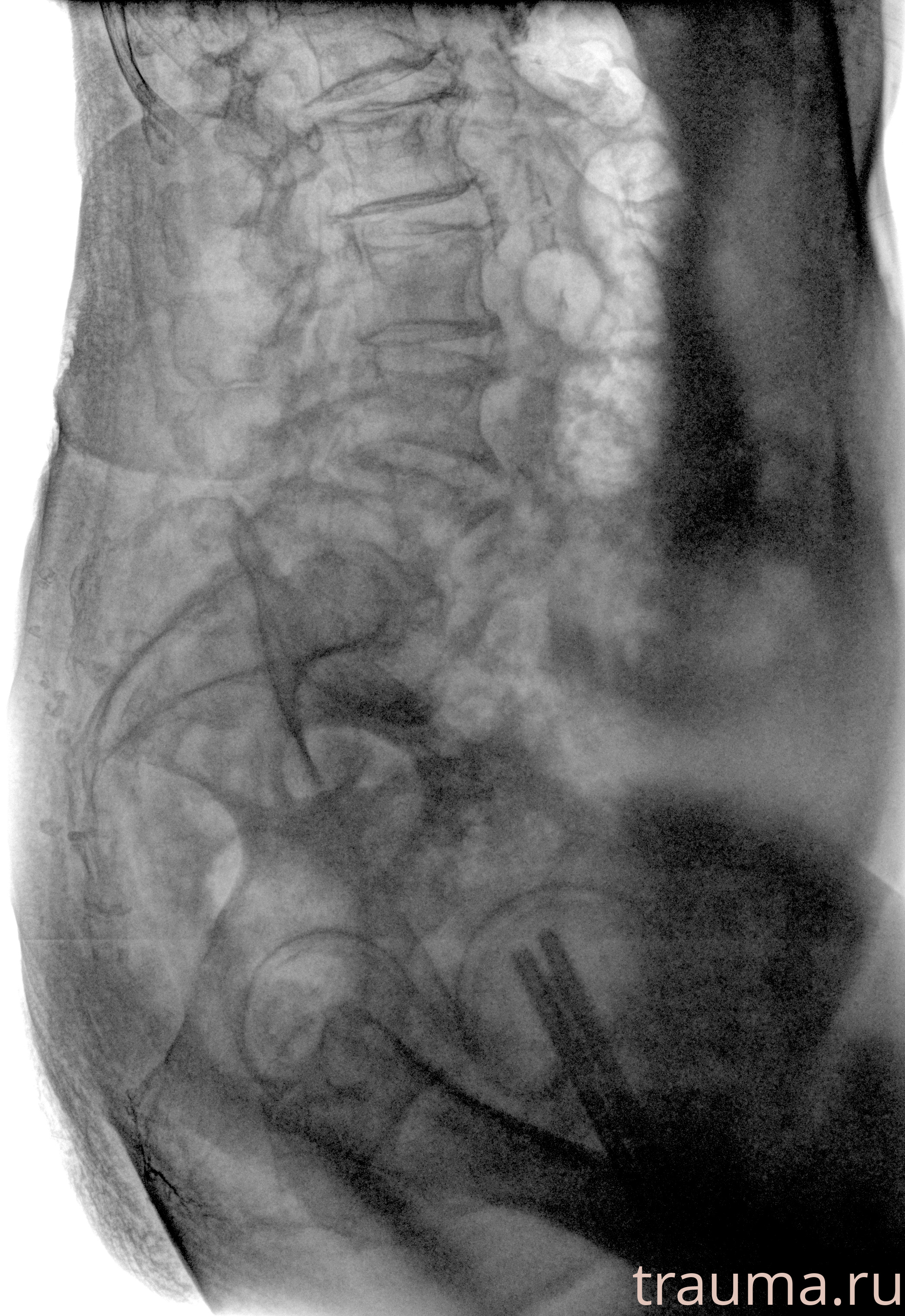 Рентген на дому: по вашему адресу приезжает врач-рентгенолог, травматолог-ортопед с мобильным рентгеновским аппаратом, проводит диагностику травмы или заболевания, делает необходимые рентгенограммы, дает рекомендации по дальнейшему лечению. Получить качественные снимки в домашних условиях возможно благодаря уникальной методике, разработанной МосРентген Центром для института  Склифосовского
