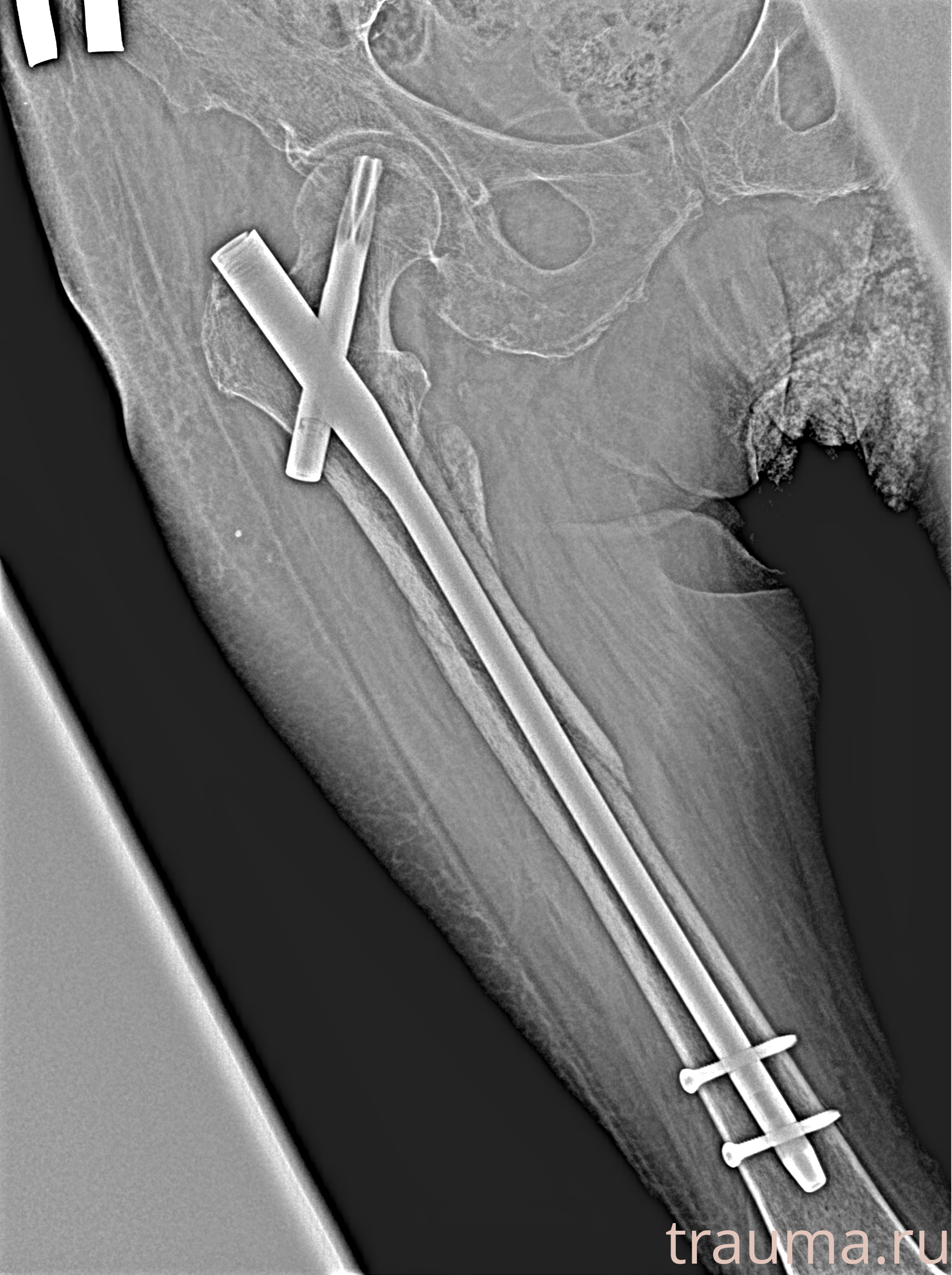 Рентген на дому: по вашему адресу приезжает врач-рентгенолог, травматолог-ортопед с мобильным рентгеновским аппаратом, проводит диагностику травмы или заболевания, делает необходимые рентгенограммы, дает рекомендации по дальнейшему лечению. Получить качественные снимки в домашних условиях возможно благодаря уникальной методике, разработанной МосРентген Центром для института  Склифосовского