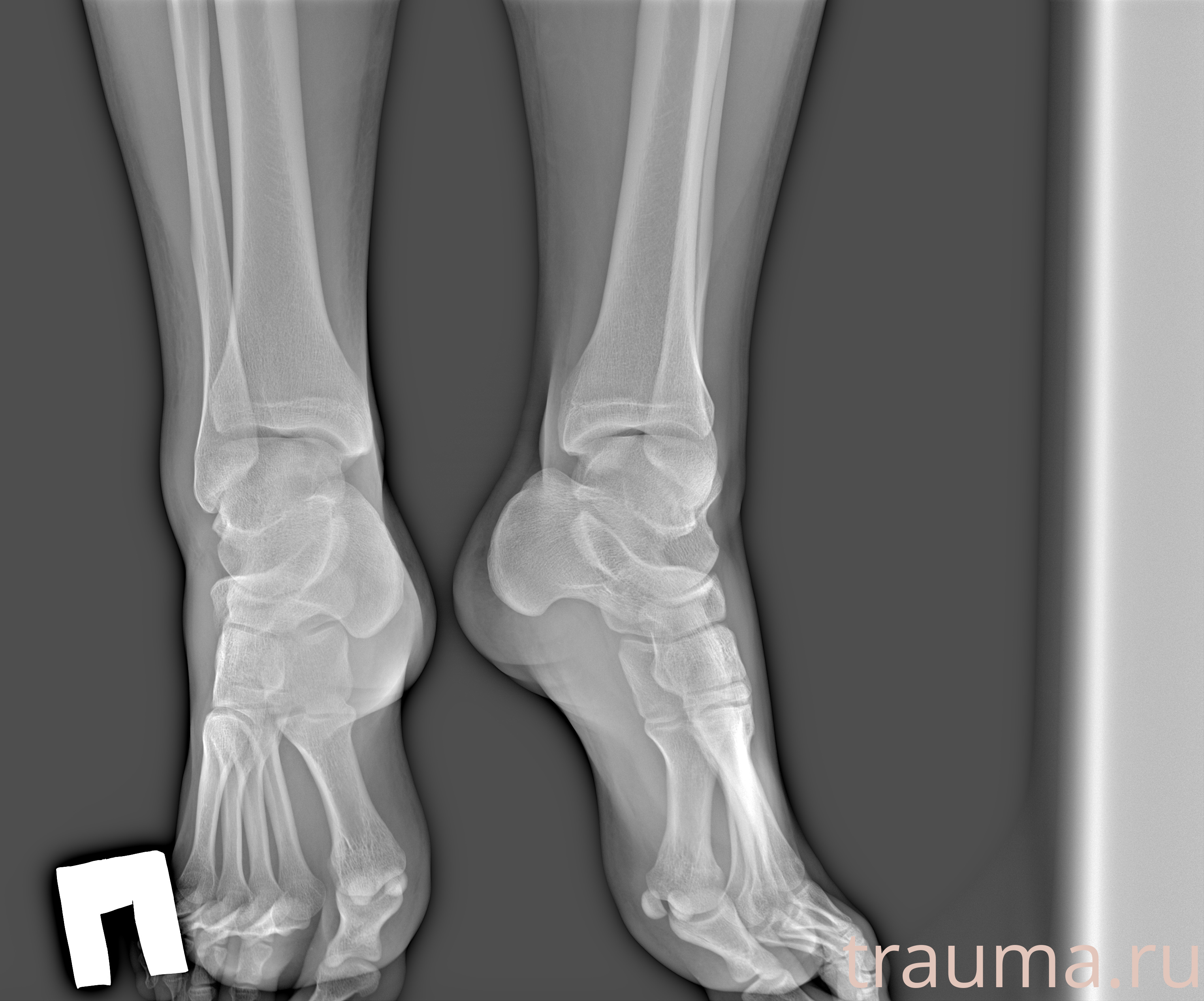 Рентген на дому: по вашему адресу приезжает врач-рентгенолог, травматолог-ортопед с мобильным рентгеновским аппаратом, проводит диагностику травмы или заболевания, делает необходимые рентгенограммы, дает рекомендации по дальнейшему лечению. Получить качественные снимки в домашних условиях возможно благодаря уникальной методике, разработанной МосРентген Центром для института  Склифосовского