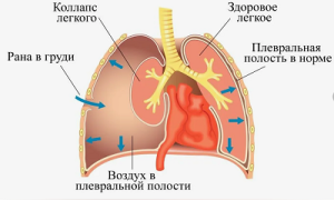 Коллапс Коллапс