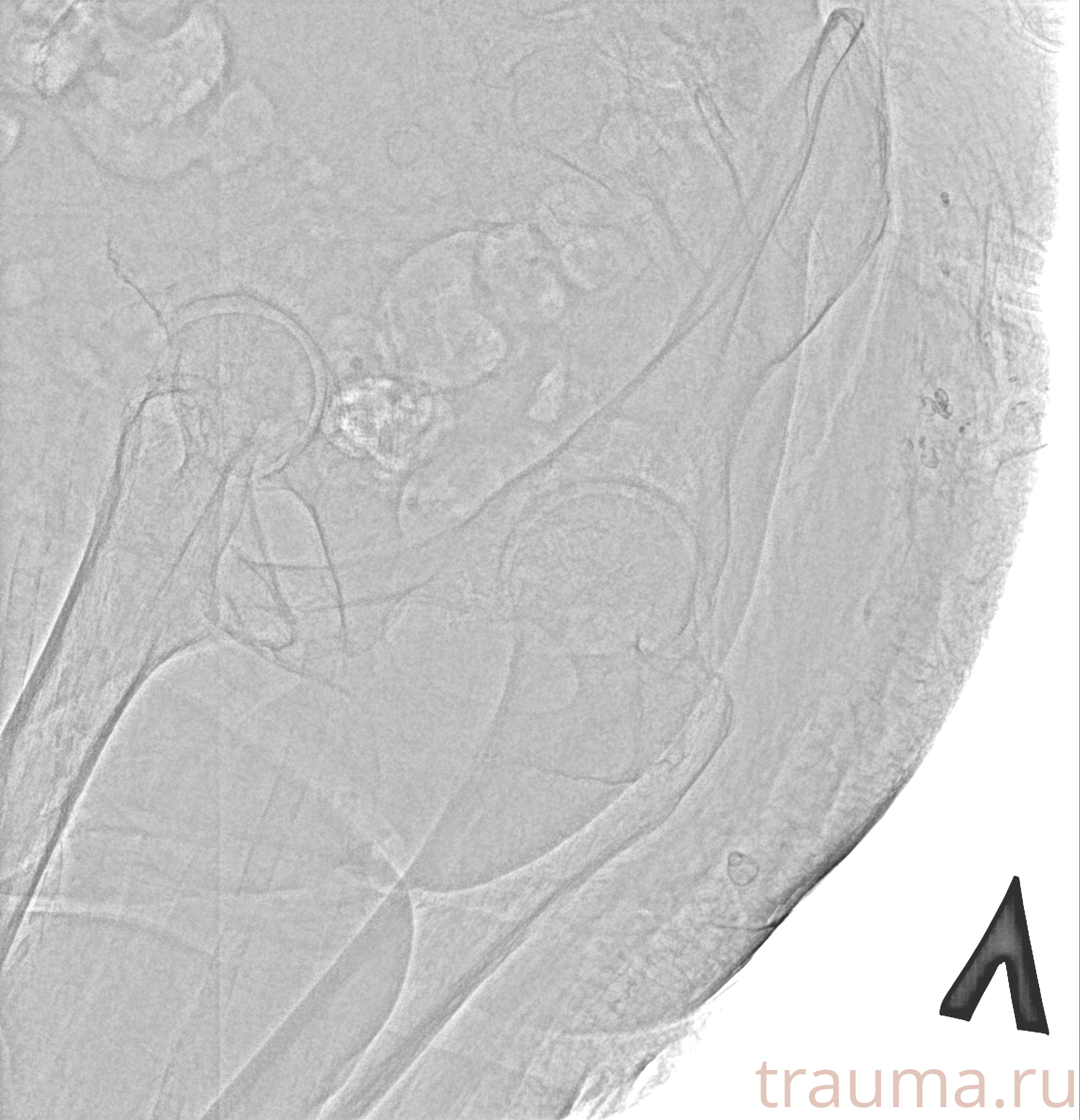 Рентген на дому: по вашему адресу приезжает врач-рентгенолог, травматолог-ортопед с мобильным рентгеновским аппаратом, проводит диагностику травмы или заболевания, делает необходимые рентгенограммы, дает рекомендации по дальнейшему лечению. Получить качественные снимки в домашних условиях возможно благодаря уникальной методике, разработанной МосРентген Центром для института  Склифосовского