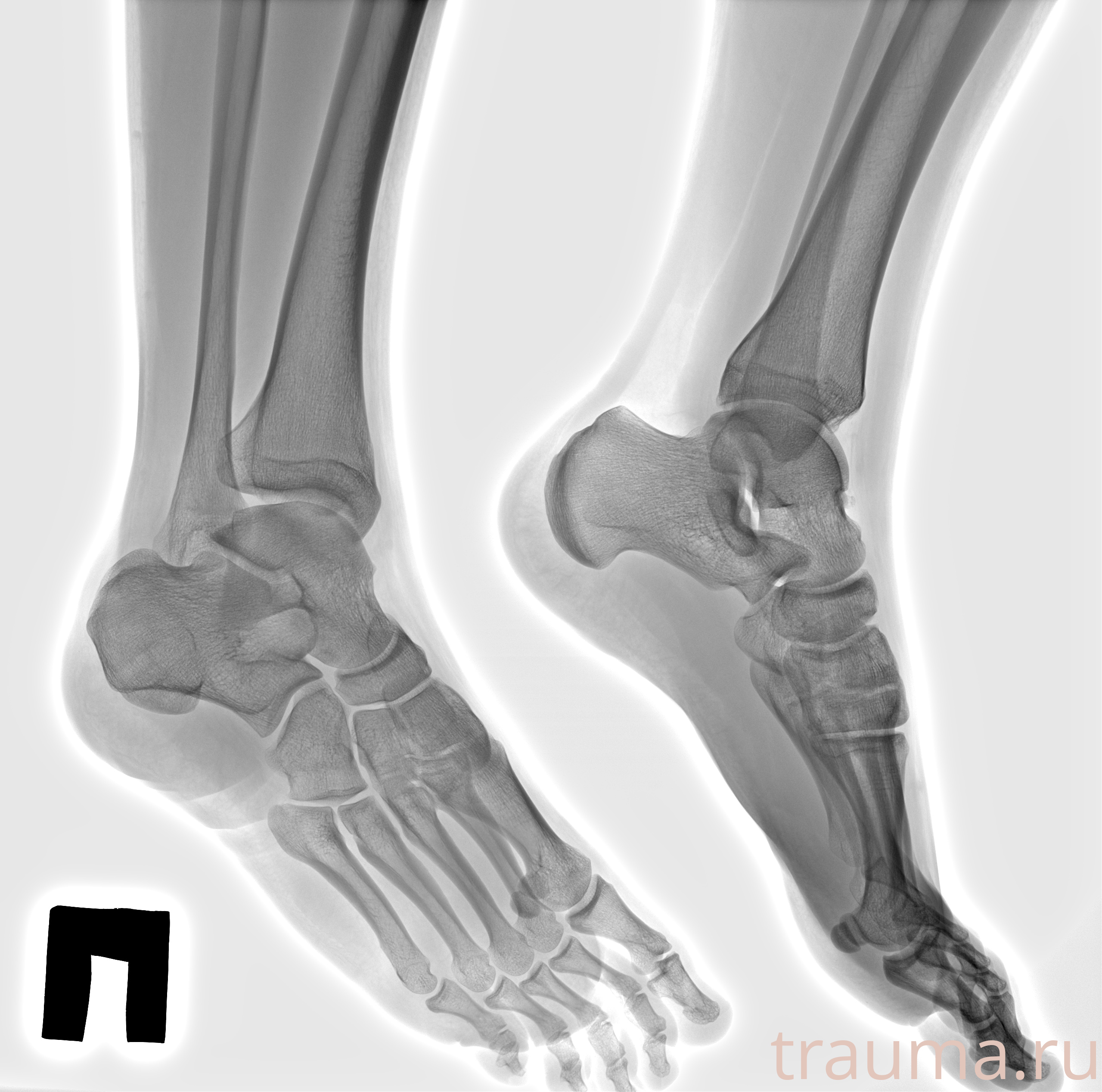 Рентген на дому: по вашему адресу приезжает врач-рентгенолог, травматолог-ортопед с мобильным рентгеновским аппаратом, проводит диагностику травмы или заболевания, делает необходимые рентгенограммы, дает рекомендации по дальнейшему лечению. Получить качественные снимки в домашних условиях возможно благодаря уникальной методике, разработанной МосРентген Центром для института  Склифосовского