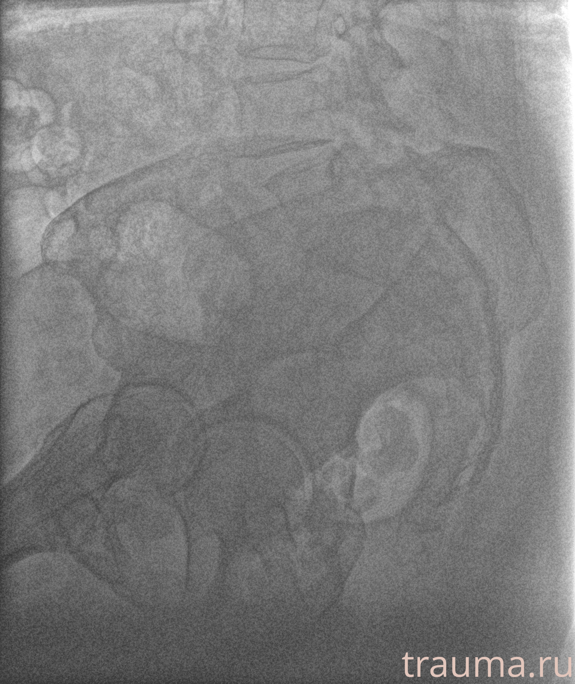 Рентген на дому: по вашему адресу приезжает врач-рентгенолог, травматолог-ортопед с мобильным рентгеновским аппаратом, проводит диагностику травмы или заболевания, делает необходимые рентгенограммы, дает рекомендации по дальнейшему лечению. Получить качественные снимки в домашних условиях возможно благодаря уникальной методике, разработанной МосРентген Центром для института  Склифосовского