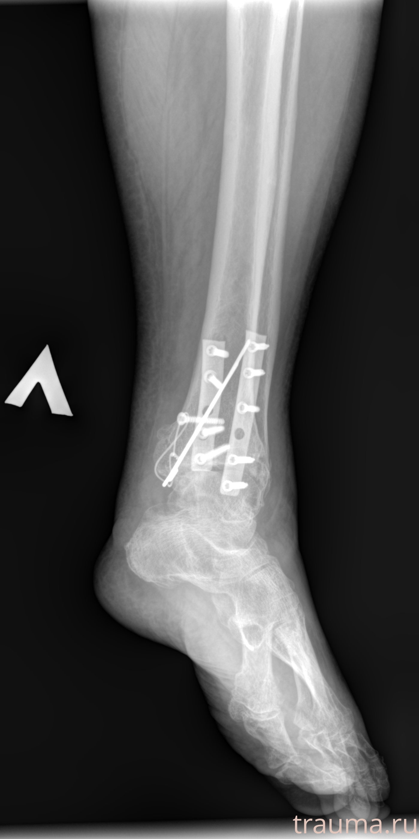 Рентген на дому: по вашему адресу приезжает врач-рентгенолог, травматолог-ортопед с мобильным рентгеновским аппаратом, проводит диагностику травмы или заболевания, делает необходимые рентгенограммы, дает рекомендации по дальнейшему лечению. Получить качественные снимки в домашних условиях возможно благодаря уникальной методике, разработанной МосРентген Центром для института  Склифосовского