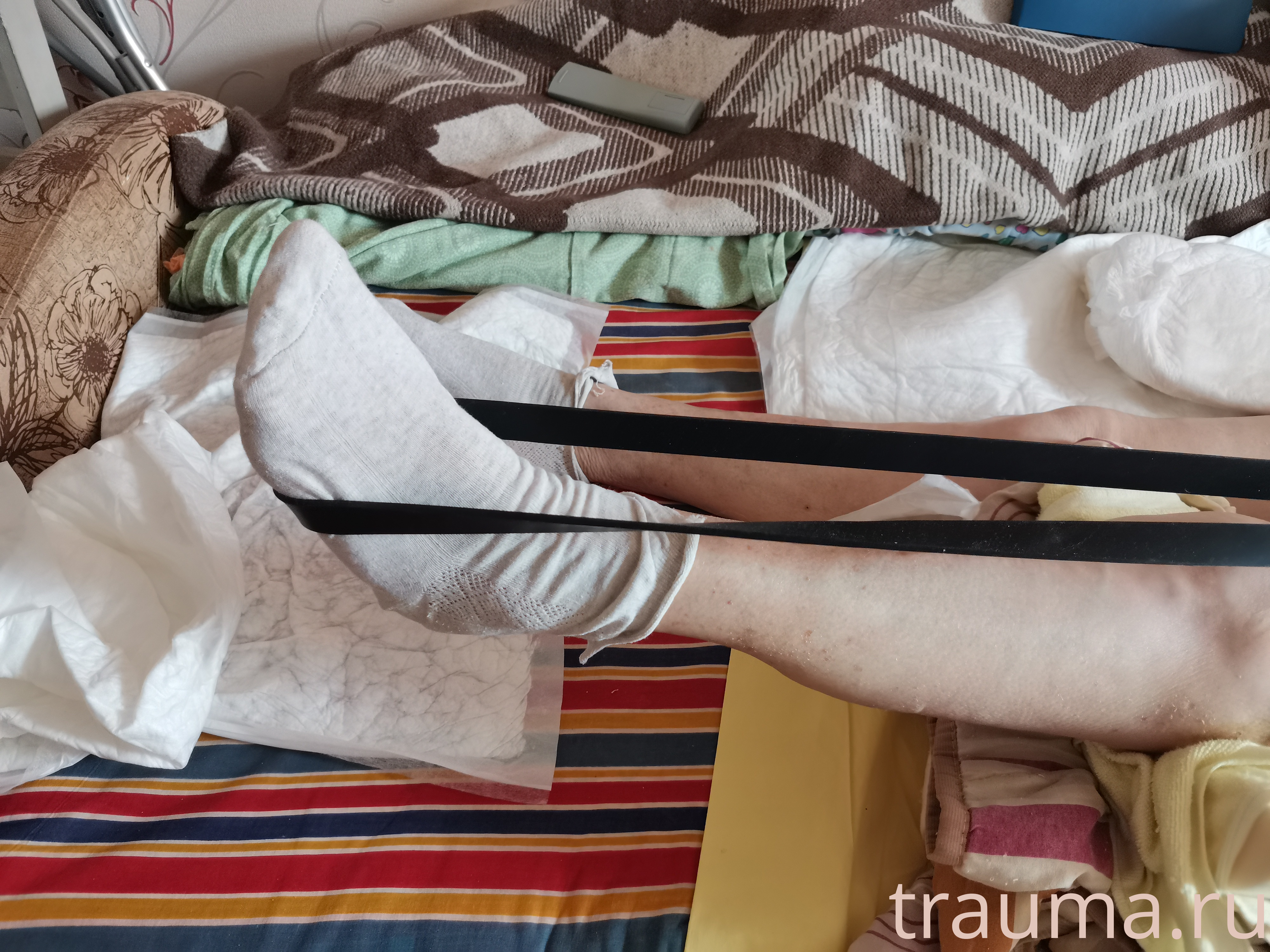 Рентген на дому: по вашему адресу приезжает врач-рентгенолог, травматолог-ортопед с мобильным рентгеновским аппаратом, проводит диагностику травмы или заболевания, делает необходимые рентгенограммы, дает рекомендации по дальнейшему лечению. Получить качественные снимки в домашних условиях возможно благодаря уникальной методике, разработанной МосРентген Центром для института  Склифосовского