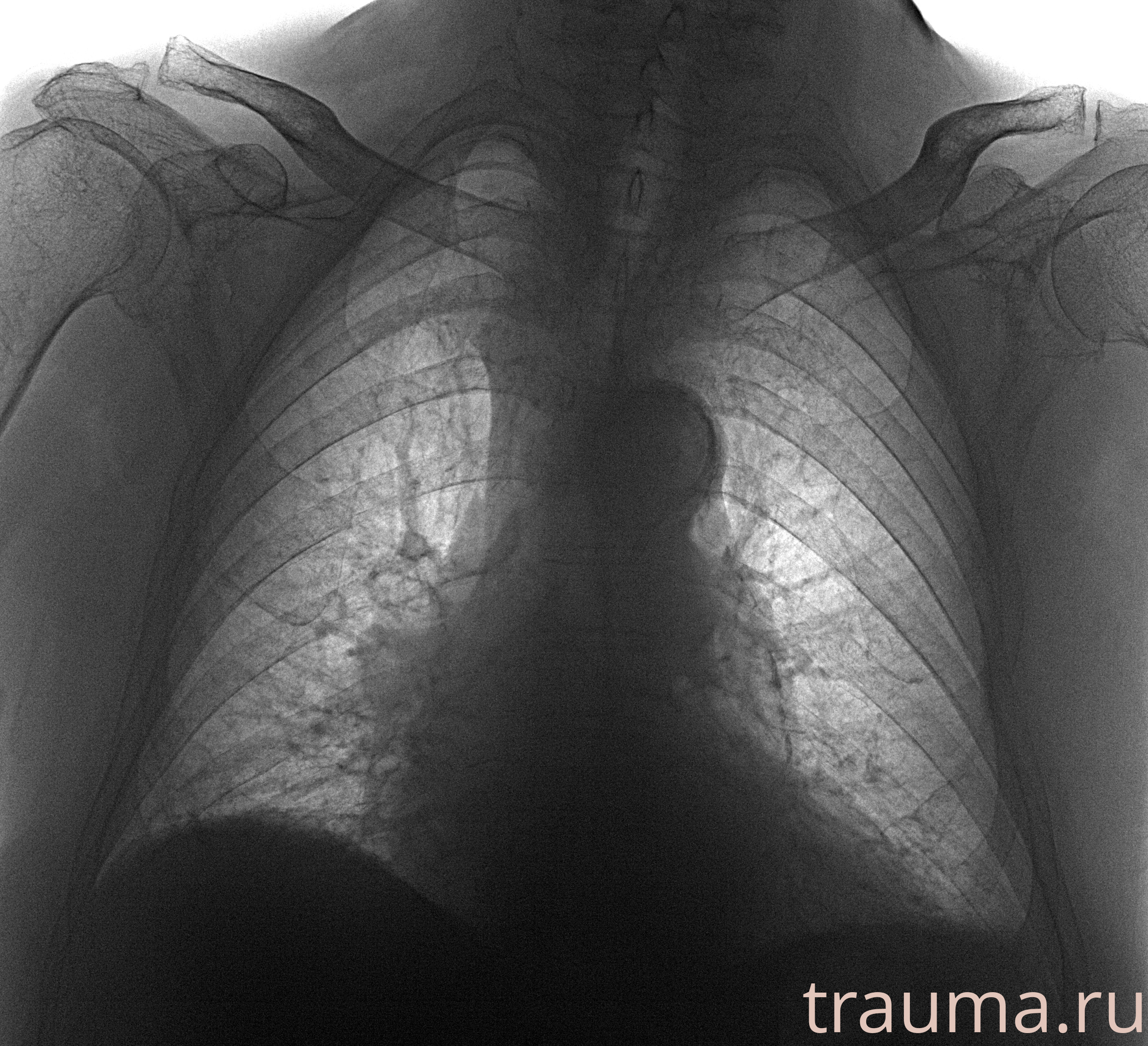 Рентген на дому: по вашему адресу приезжает врач-рентгенолог, травматолог-ортопед с мобильным рентгеновским аппаратом, проводит диагностику травмы или заболевания, делает необходимые рентгенограммы, дает рекомендации по дальнейшему лечению. Получить качественные снимки в домашних условиях возможно благодаря уникальной методике, разработанной МосРентген Центром для института  Склифосовского