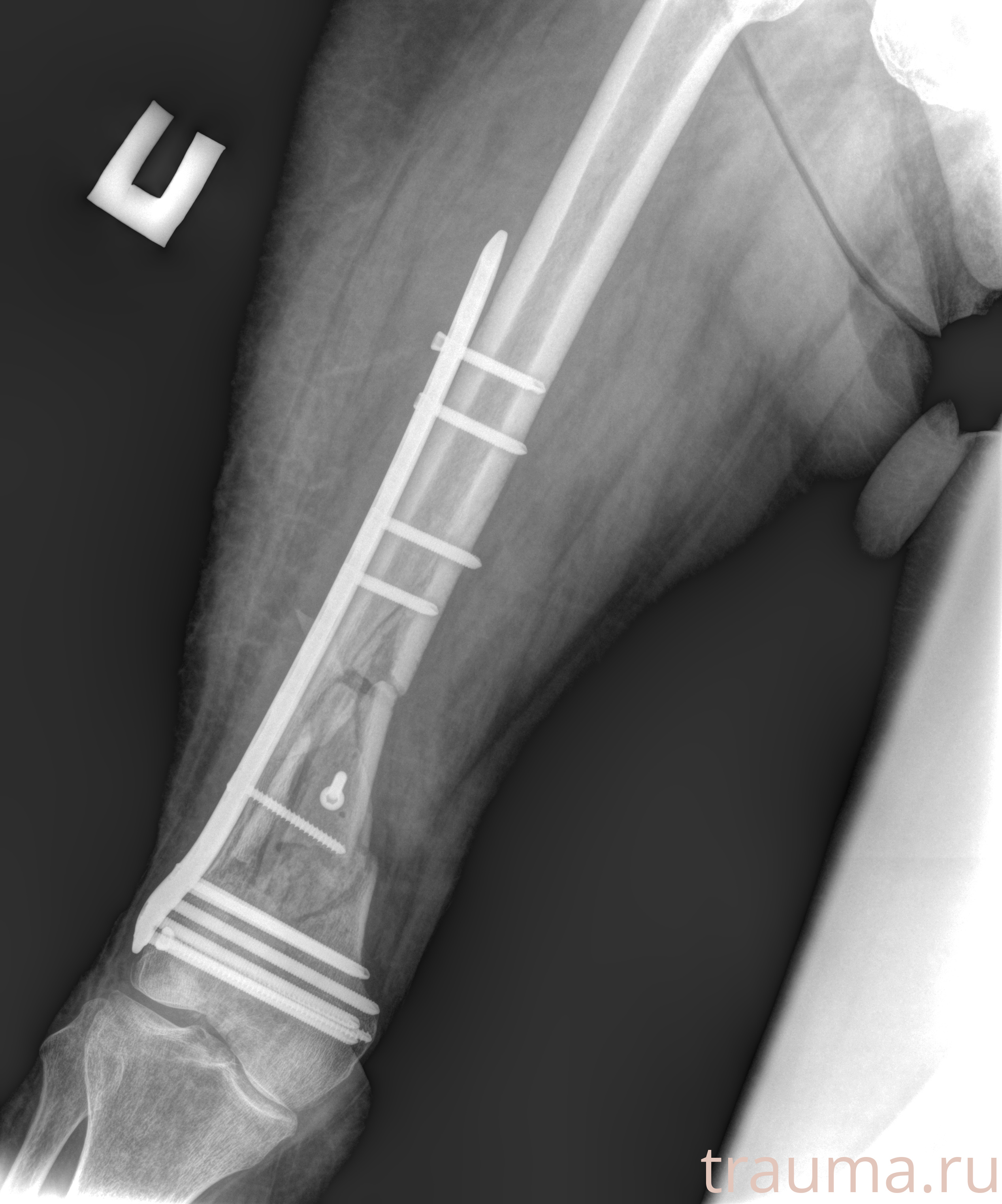 Рентген на дому: по вашему адресу приезжает врач-рентгенолог, травматолог-ортопед с мобильным рентгеновским аппаратом, проводит диагностику травмы или заболевания, делает необходимые рентгенограммы, дает рекомендации по дальнейшему лечению. Получить качественные снимки в домашних условиях возможно благодаря уникальной методике, разработанной МосРентген Центром для института  Склифосовского