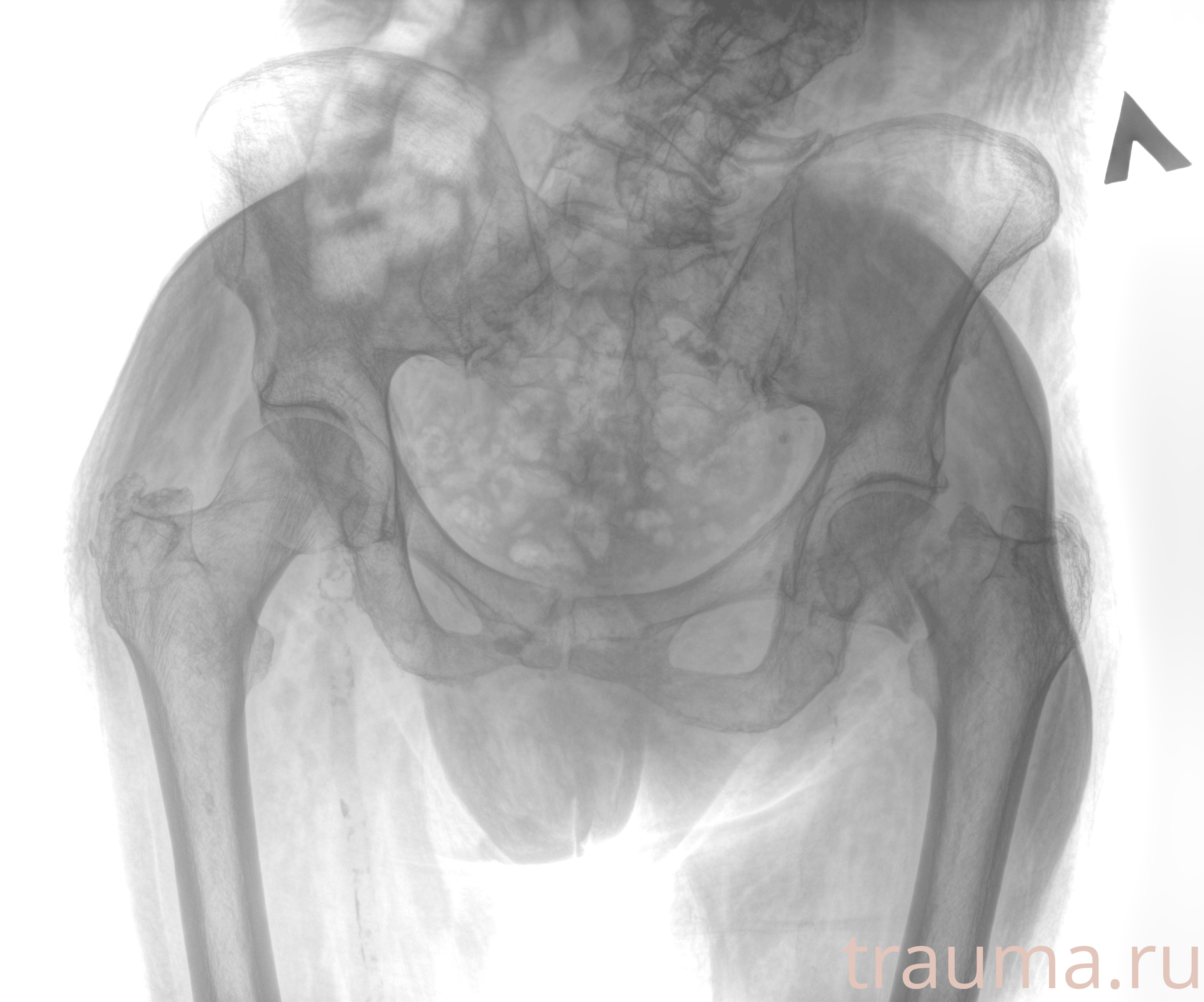 Рентген на дому: по вашему адресу приезжает врач-рентгенолог, травматолог-ортопед с мобильным рентгеновским аппаратом, проводит диагностику травмы или заболевания, делает необходимые рентгенограммы, дает рекомендации по дальнейшему лечению. Получить качественные снимки в домашних условиях возможно благодаря уникальной методике, разработанной МосРентген Центром для института  Склифосовского