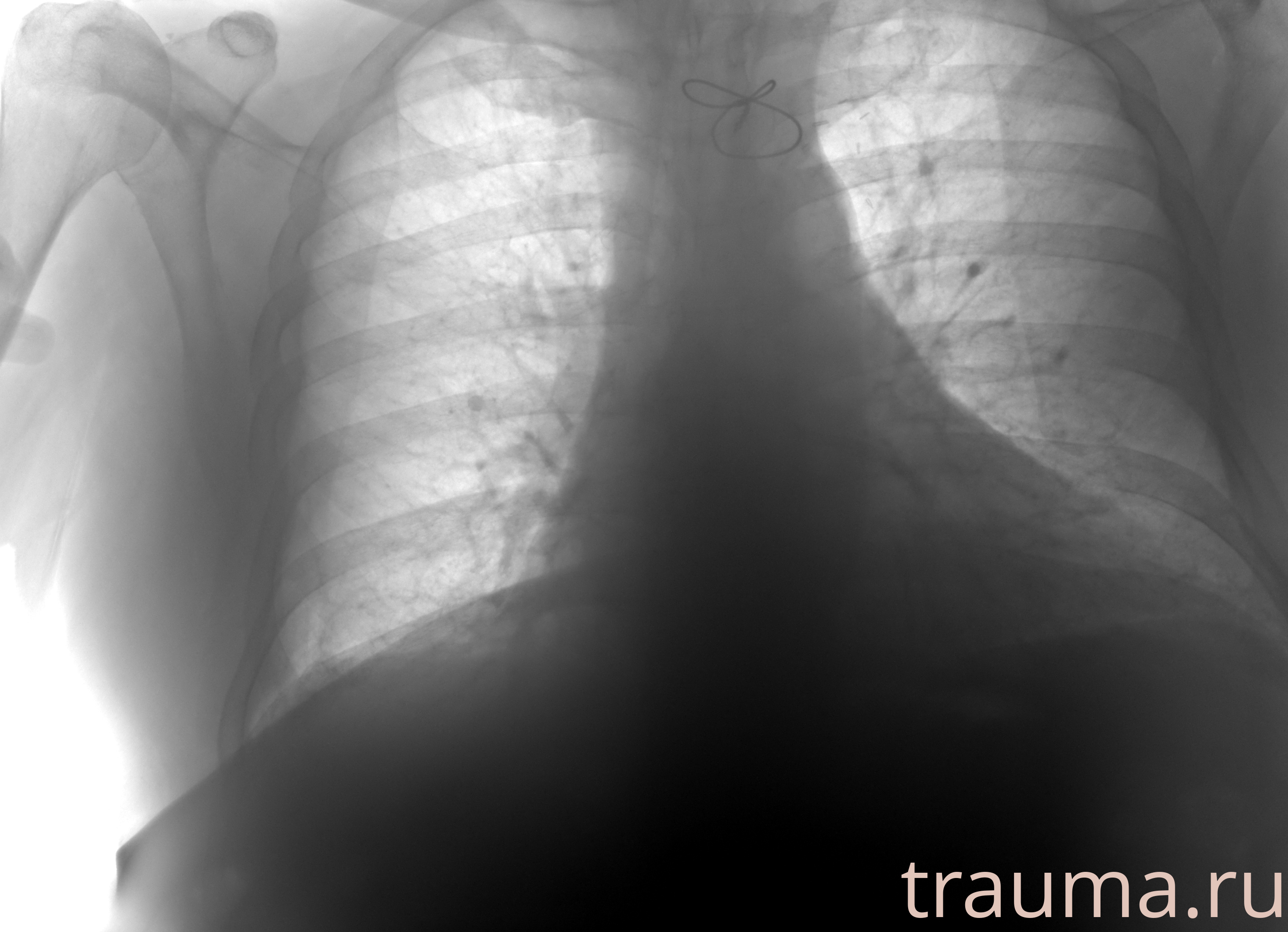 Рентген на дому: по вашему адресу приезжает врач-рентгенолог, травматолог-ортопед с мобильным рентгеновским аппаратом, проводит диагностику травмы или заболевания, делает необходимые рентгенограммы, дает рекомендации по дальнейшему лечению. Получить качественные снимки в домашних условиях возможно благодаря уникальной методике, разработанной МосРентген Центром для института  Склифосовского