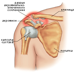 артроскопия, плечевой сустав, привычный вывих артроскопия, плечевой сустав, привычный вывих