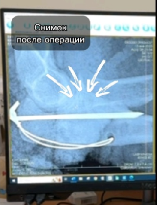 Травматологи Склифа зафиксировали осколки по специальной методике Вебера Травматологи Склифа зафиксировали осколки по специальной методике Вебера