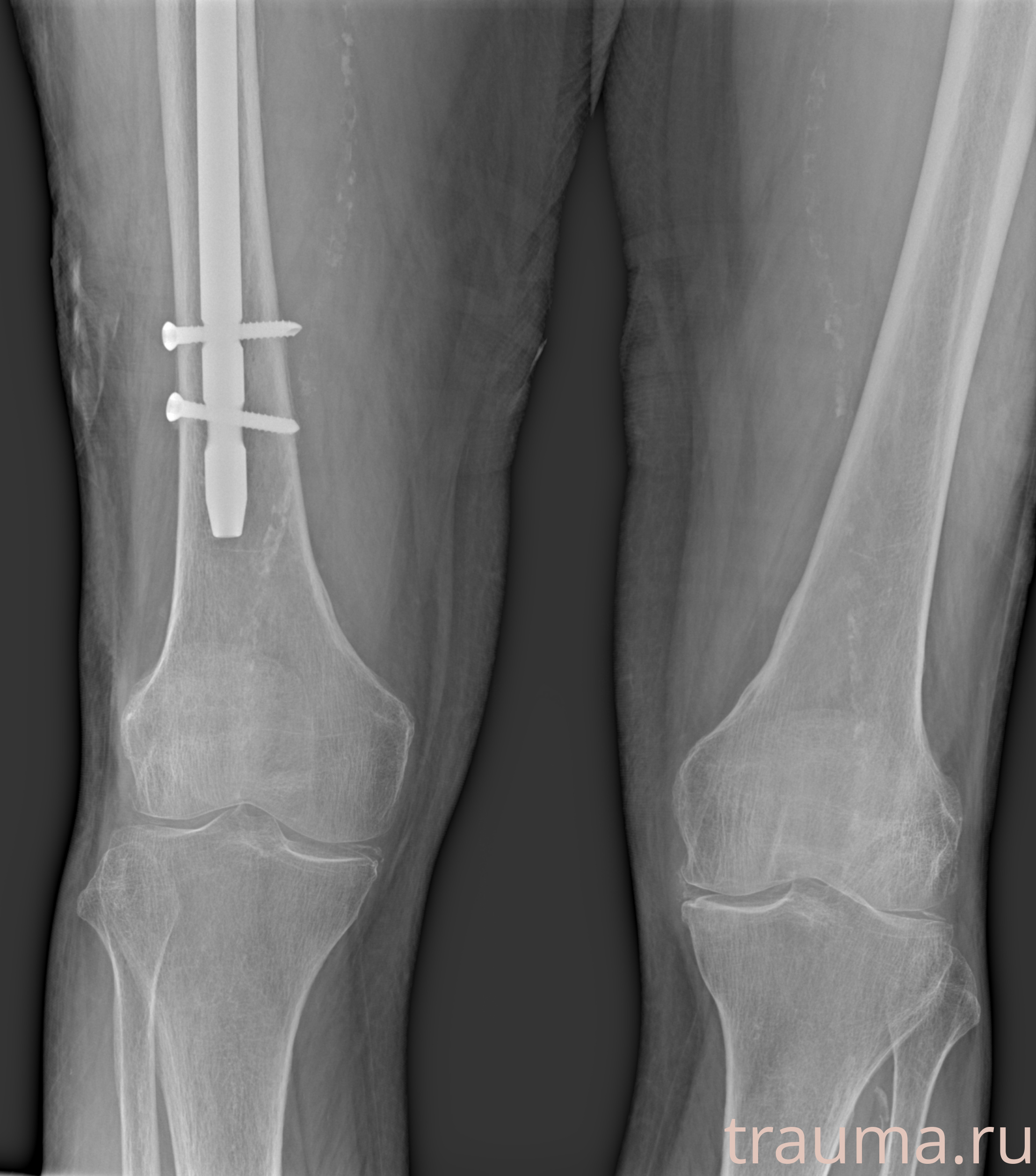 Рентген на дому: по вашему адресу приезжает врач-рентгенолог, травматолог-ортопед с мобильным рентгеновским аппаратом, проводит диагностику травмы или заболевания, делает необходимые рентгенограммы, дает рекомендации по дальнейшему лечению. Получить качественные снимки в домашних условиях возможно благодаря уникальной методике, разработанной МосРентген Центром для института  Склифосовского