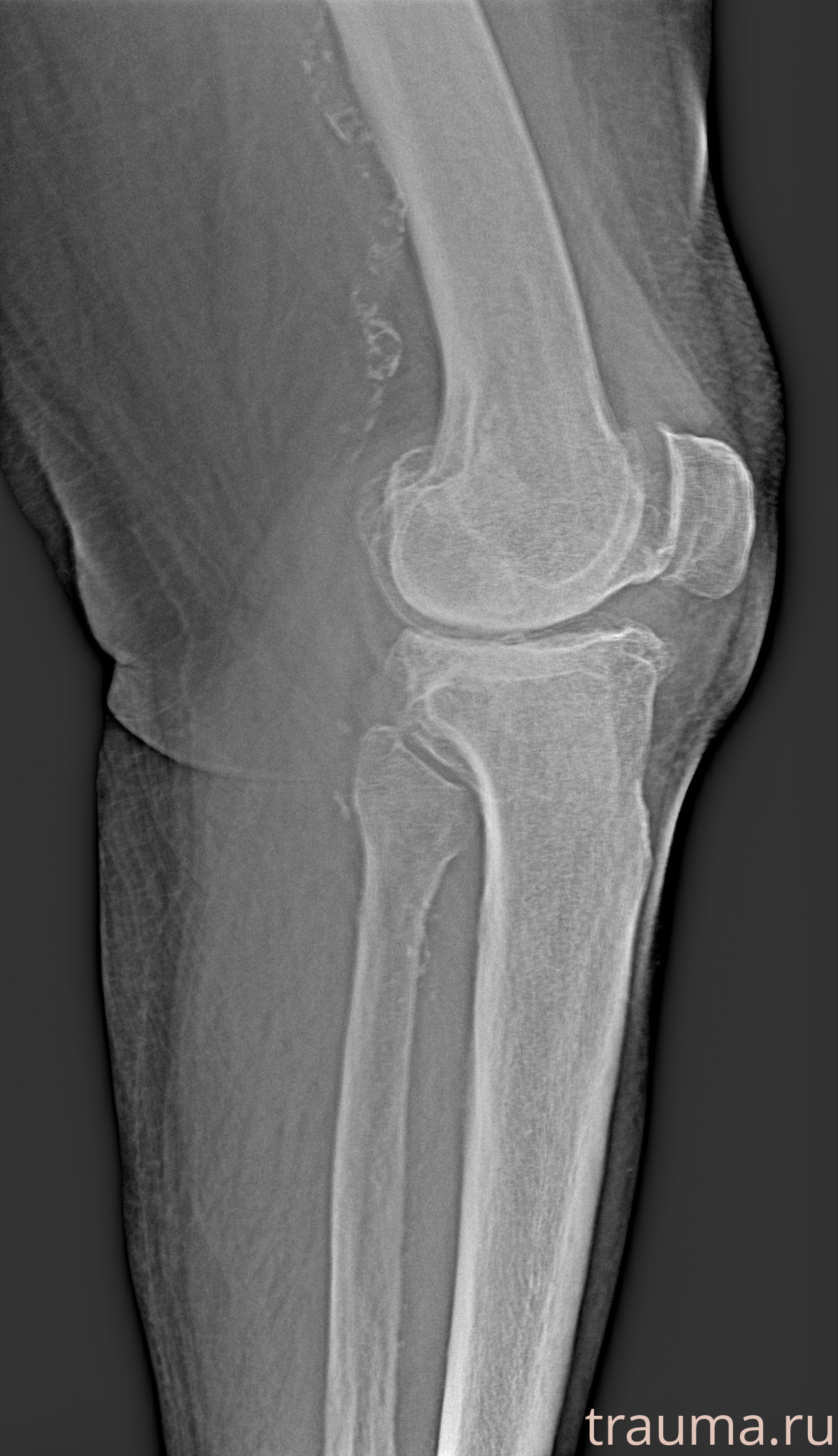 Рентген на дому: по вашему адресу приезжает врач-рентгенолог, травматолог-ортопед с мобильным рентгеновским аппаратом, проводит диагностику травмы или заболевания, делает необходимые рентгенограммы, дает рекомендации по дальнейшему лечению. Получить качественные снимки в домашних условиях возможно благодаря уникальной методике, разработанной МосРентген Центром для института  Склифосовского