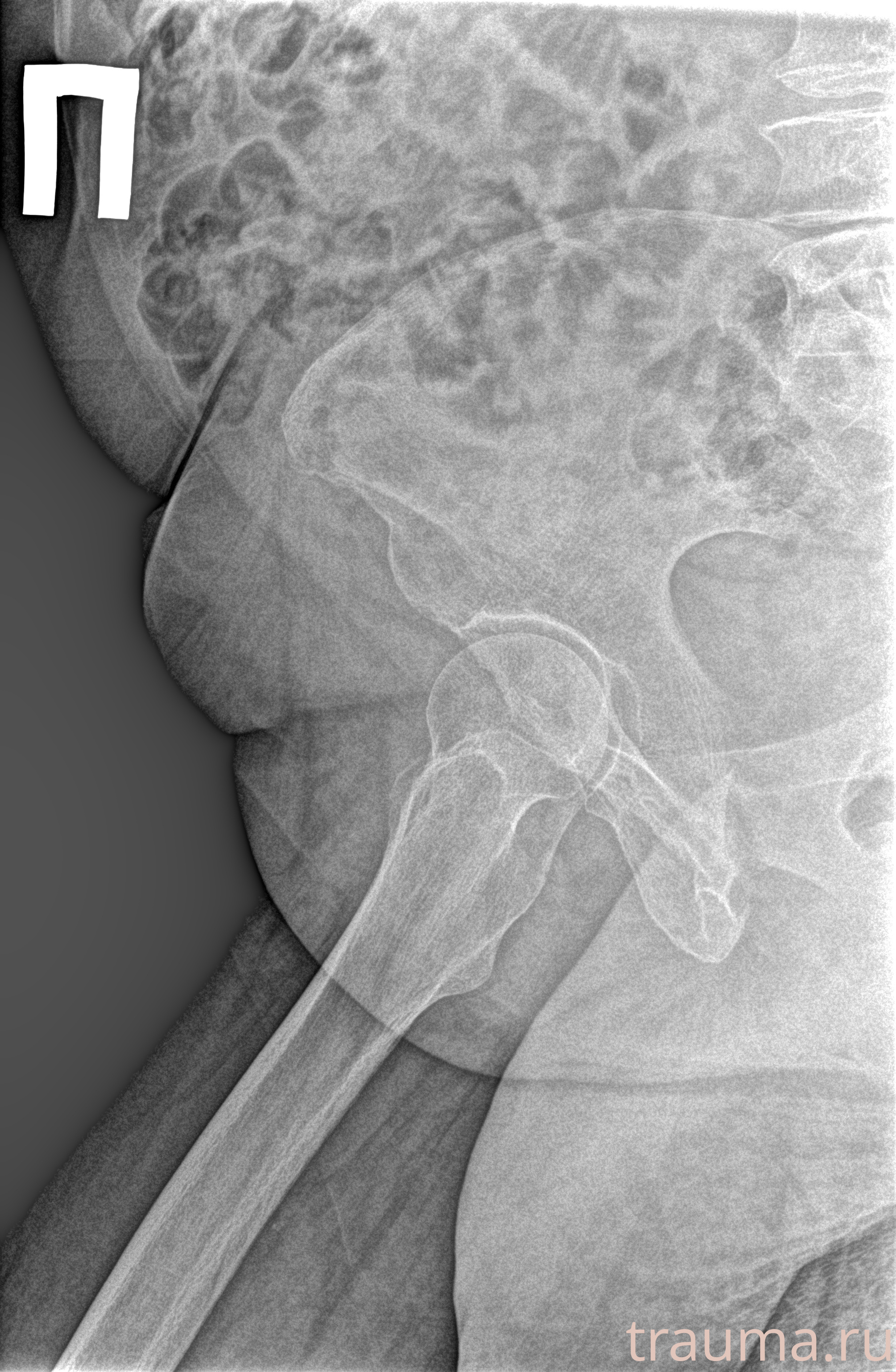 Рентген на дому: по вашему адресу приезжает врач-рентгенолог, травматолог-ортопед с мобильным рентгеновским аппаратом, проводит диагностику травмы или заболевания, делает необходимые рентгенограммы, дает рекомендации по дальнейшему лечению. Получить качественные снимки в домашних условиях возможно благодаря уникальной методике, разработанной МосРентген Центром для института  Склифосовского