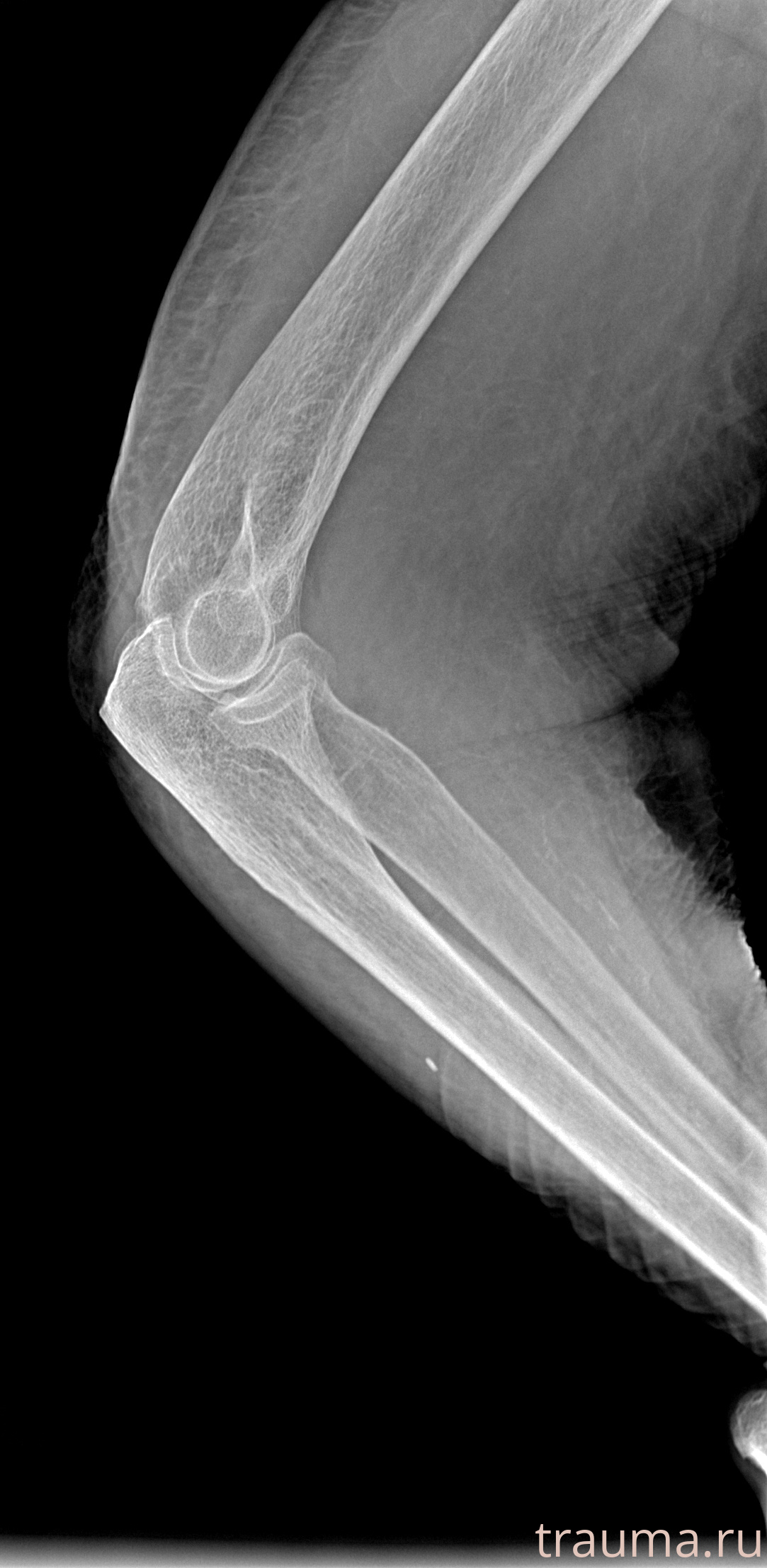 Рентген на дому: по вашему адресу приезжает врач-рентгенолог, травматолог-ортопед с мобильным рентгеновским аппаратом, проводит диагностику травмы или заболевания, делает необходимые рентгенограммы, дает рекомендации по дальнейшему лечению. Получить качественные снимки в домашних условиях возможно благодаря уникальной методике, разработанной МосРентген Центром для института  Склифосовского