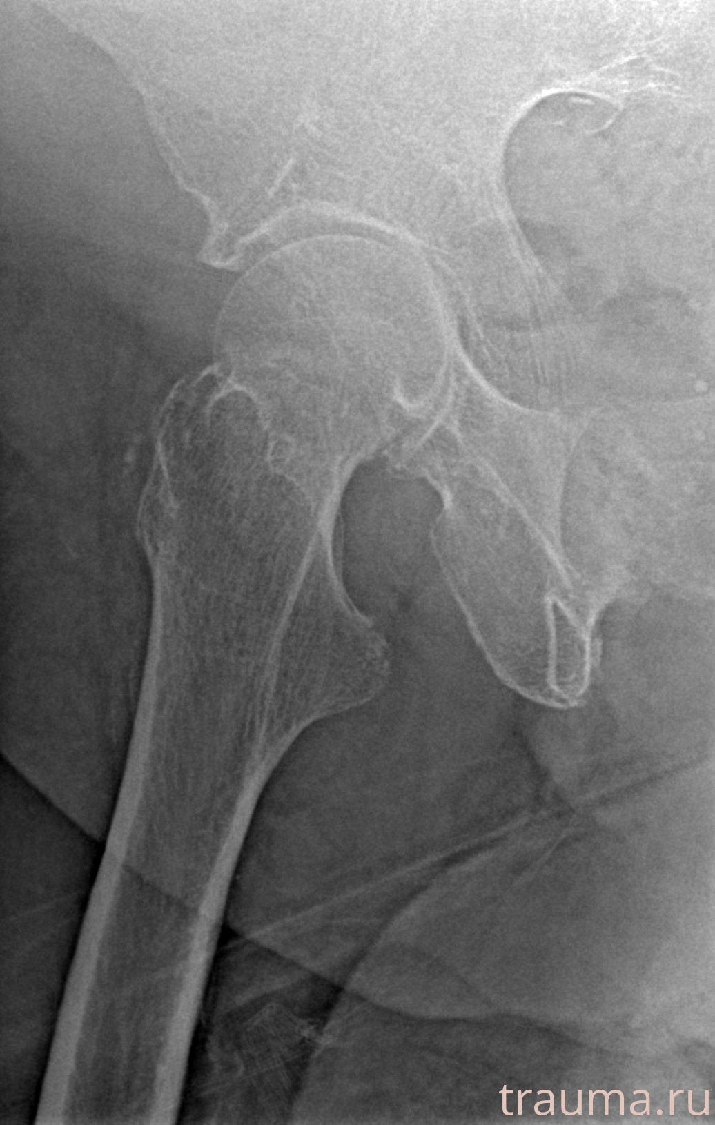 Рентген на дому: по вашему адресу приезжает врач-рентгенолог, травматолог-ортопед с мобильным рентгеновским аппаратом, проводит диагностику травмы или заболевания, делает необходимые рентгенограммы, дает рекомендации по дальнейшему лечению. Получить качественные снимки в домашних условиях возможно благодаря уникальной методике, разработанной МосРентген Центром для института  Склифосовского