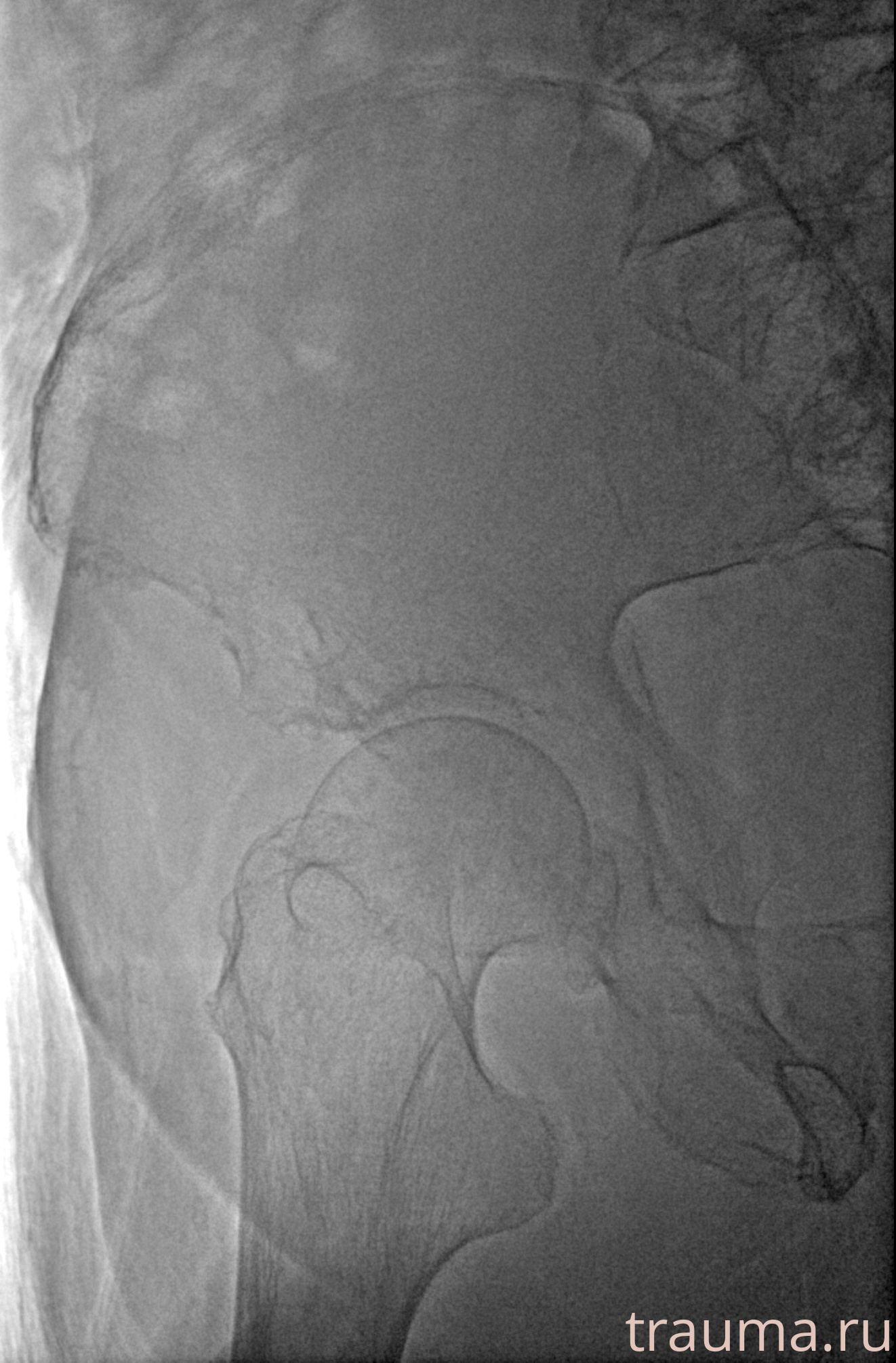 Рентген на дому: по вашему адресу приезжает врач-рентгенолог, травматолог-ортопед с мобильным рентгеновским аппаратом, проводит диагностику травмы или заболевания, делает необходимые рентгенограммы, дает рекомендации по дальнейшему лечению. Получить качественные снимки в домашних условиях возможно благодаря уникальной методике, разработанной МосРентген Центром для института  Склифосовского