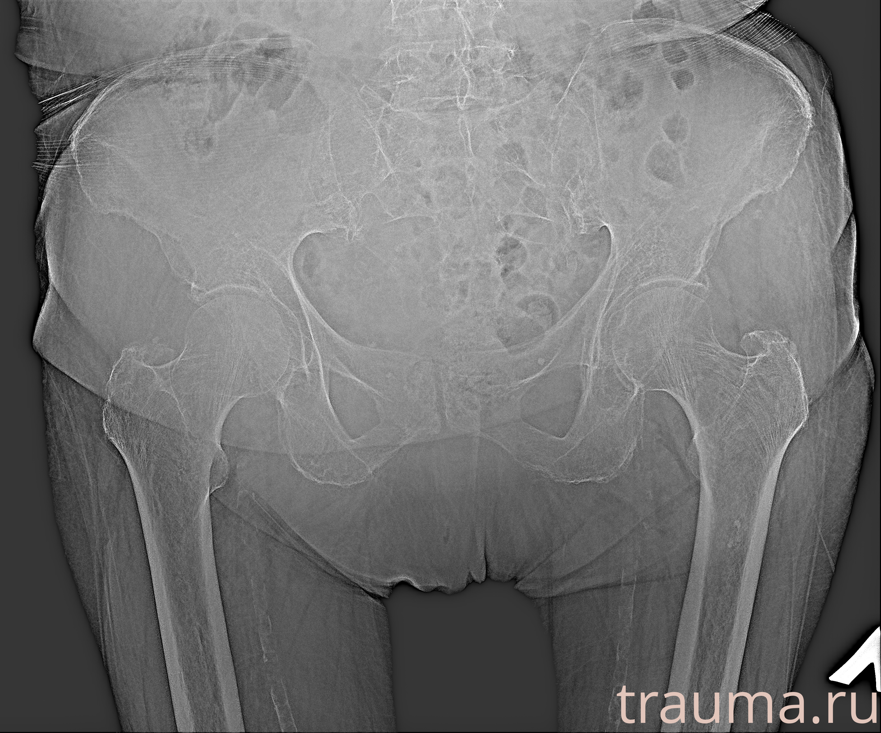 Рентген на дому: по вашему адресу приезжает врач-рентгенолог, травматолог-ортопед с мобильным рентгеновским аппаратом, проводит диагностику травмы или заболевания, делает необходимые рентгенограммы, дает рекомендации по дальнейшему лечению. Получить качественные снимки в домашних условиях возможно благодаря уникальной методике, разработанной МосРентген Центром для института  Склифосовского