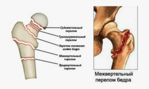 Успешное хирургическое лечение пациентки с переломом проксимального отдела бедренной кости