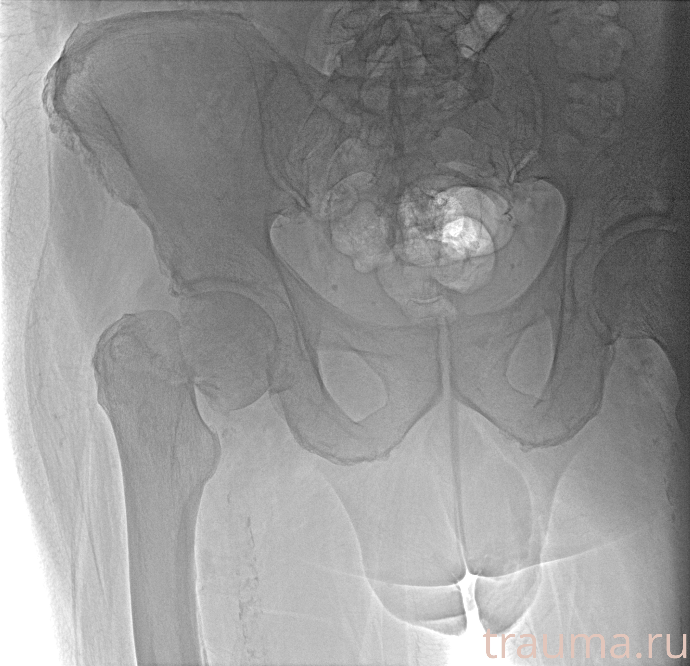 Рентген на дому: по вашему адресу приезжает врач-рентгенолог, травматолог-ортопед с мобильным рентгеновским аппаратом, проводит диагностику травмы или заболевания, делает необходимые рентгенограммы, дает рекомендации по дальнейшему лечению. Получить качественные снимки в домашних условиях возможно благодаря уникальной методике, разработанной МосРентген Центром для института  Склифосовского