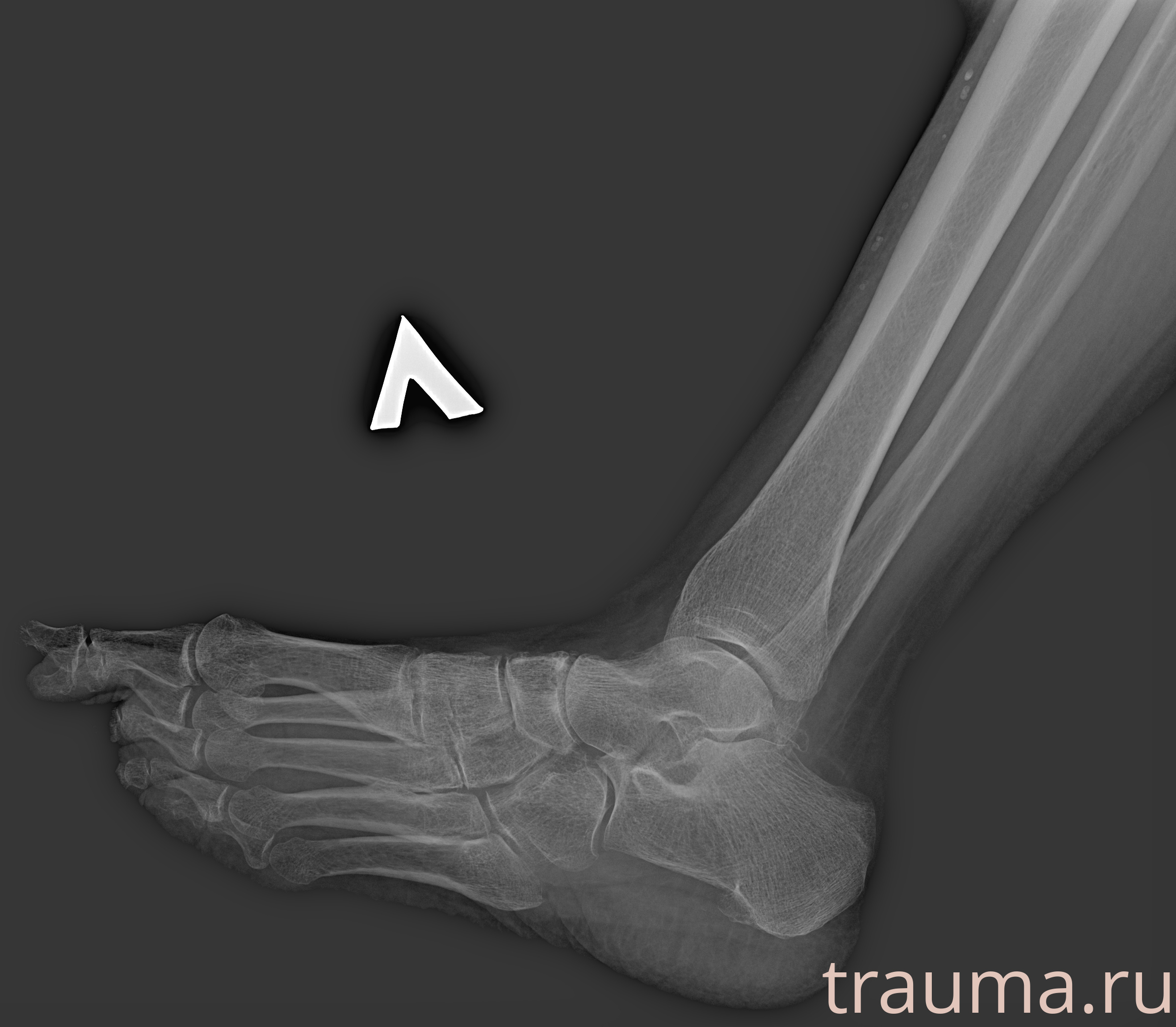 Рентген на дому: по вашему адресу приезжает врач-рентгенолог, травматолог-ортопед с мобильным рентгеновским аппаратом, проводит диагностику травмы или заболевания, делает необходимые рентгенограммы, дает рекомендации по дальнейшему лечению. Получить качественные снимки в домашних условиях возможно благодаря уникальной методике, разработанной МосРентген Центром для института  Склифосовского